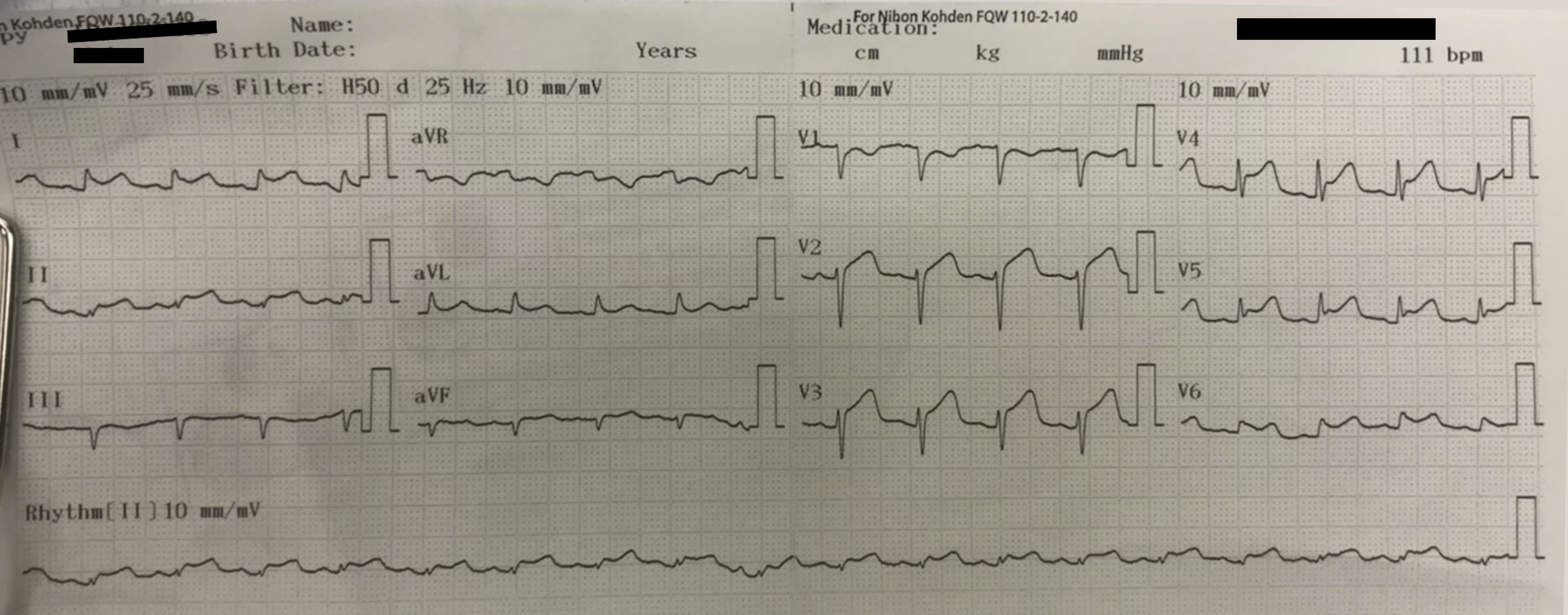 A 12-lead electrocardiogram of the patient showed sinus
tachycardia, diffused ST-segment elevations, and generalized low voltage QRS
complexes.