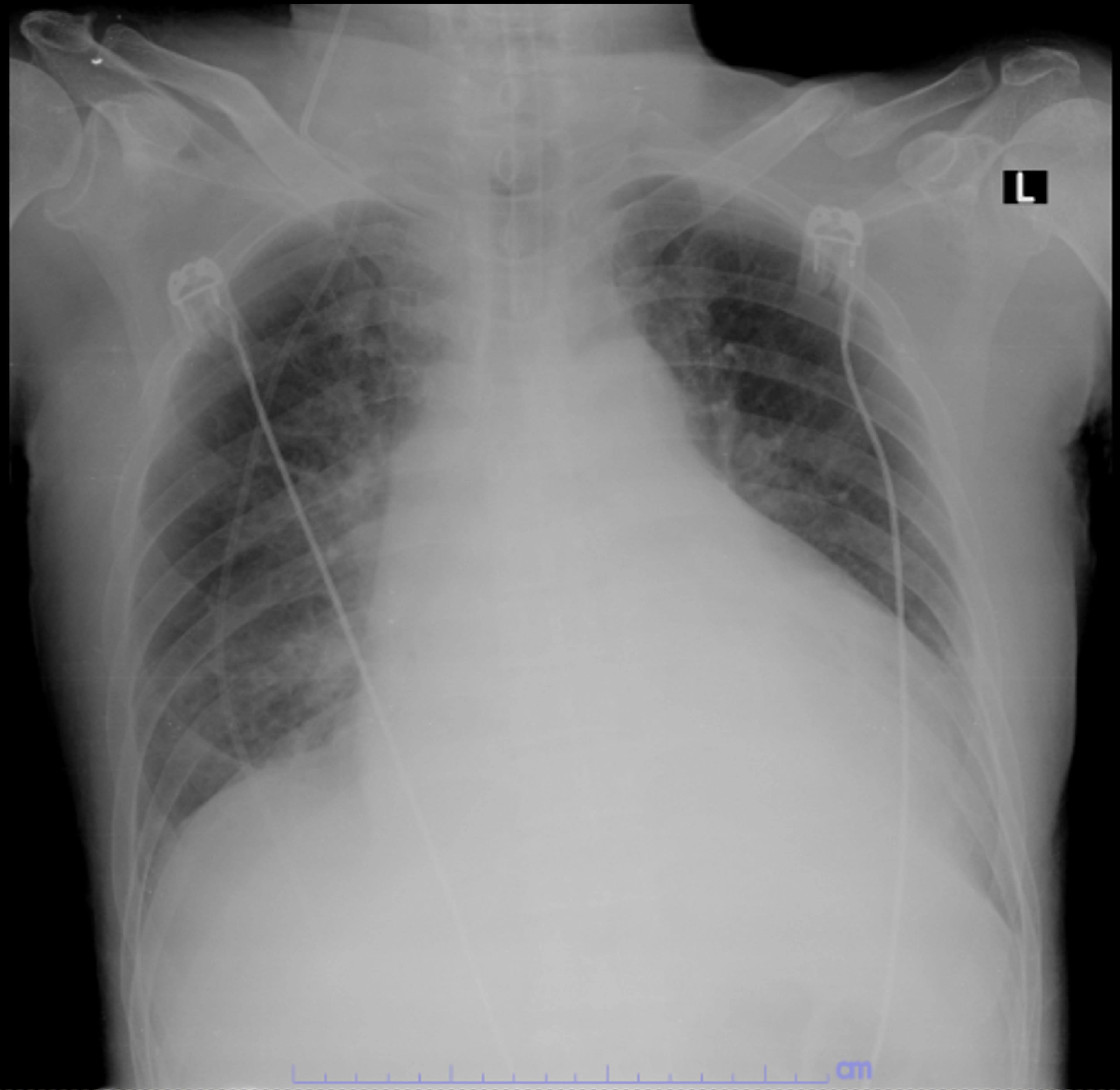 A chest X-ray revealed cardiomegaly with a widening of the
mediastinum and shaziness at bilateral lung fields.