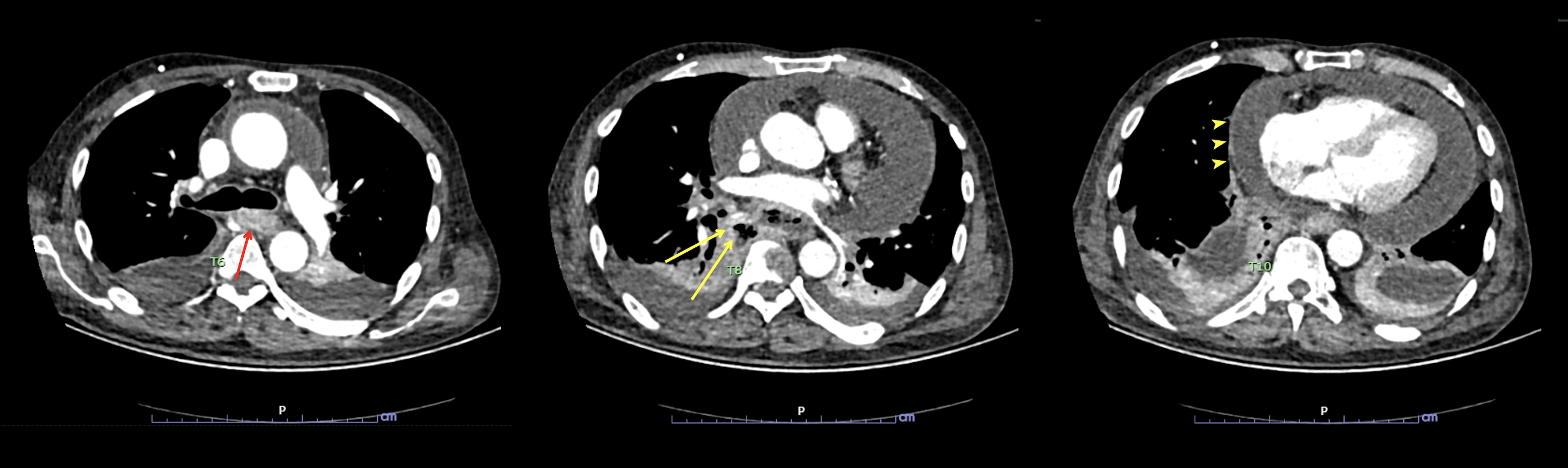 CT of the chest (axial view) showing a circumferential
thickening lesion at mid-thoracic esophagus about level of T6 spine (red arrow),
measuring 1.9 × 4.2 × 3.0 cm in maximal axial and vertical
diameters, with track-like lesion extending from the right side of this lesion
containing fluid and multiple air bubbles contiguous from the right side of the
esophagus (yellow arrows). Also, a moderate amount of pericardial effusion with
thin smooth enhancing wall (arrowheads), measuring 2.7 cm in thickness.