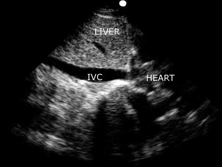 Shows sagittal proximal IVC (inferior vena cava) segment 
appearance on ultrasound at maximum expiration in one of the study patients.