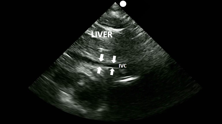 Shows a patient whose IVC collapsed incompletely upon 
inspiration.