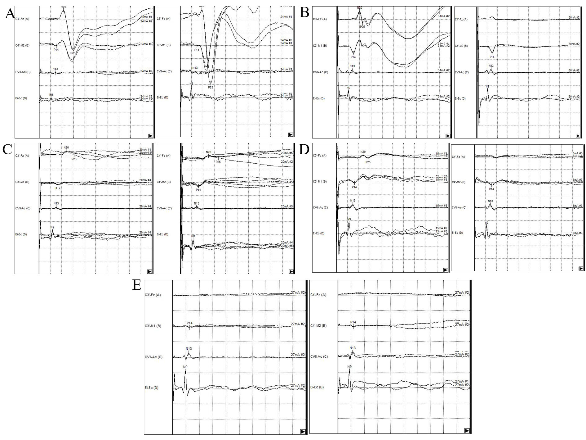 Examples of different SEP patterns obtained after median nerve
stimulation. (A) Normal on both hemispheres. (B) Normal on left hemisphere and
absent on the right hemisphere C. Absent on the right hemisphere and normal on
the left hemisphere. (C) Pathological for amplitude (<1.2 µV) on both
hemispheres. (D) Absent on the right hemisphere and pathological for amplitude
(<1.2 µV) on the left hemisphere. (E) Absent on both hemispheres. In left
columns are showed SEP components after right median nerve stimulation (cortical
responses of the left hemisphere). In right columns are showed SEP components
after left median nerve stimulation (cortical responses of right hemisphere).