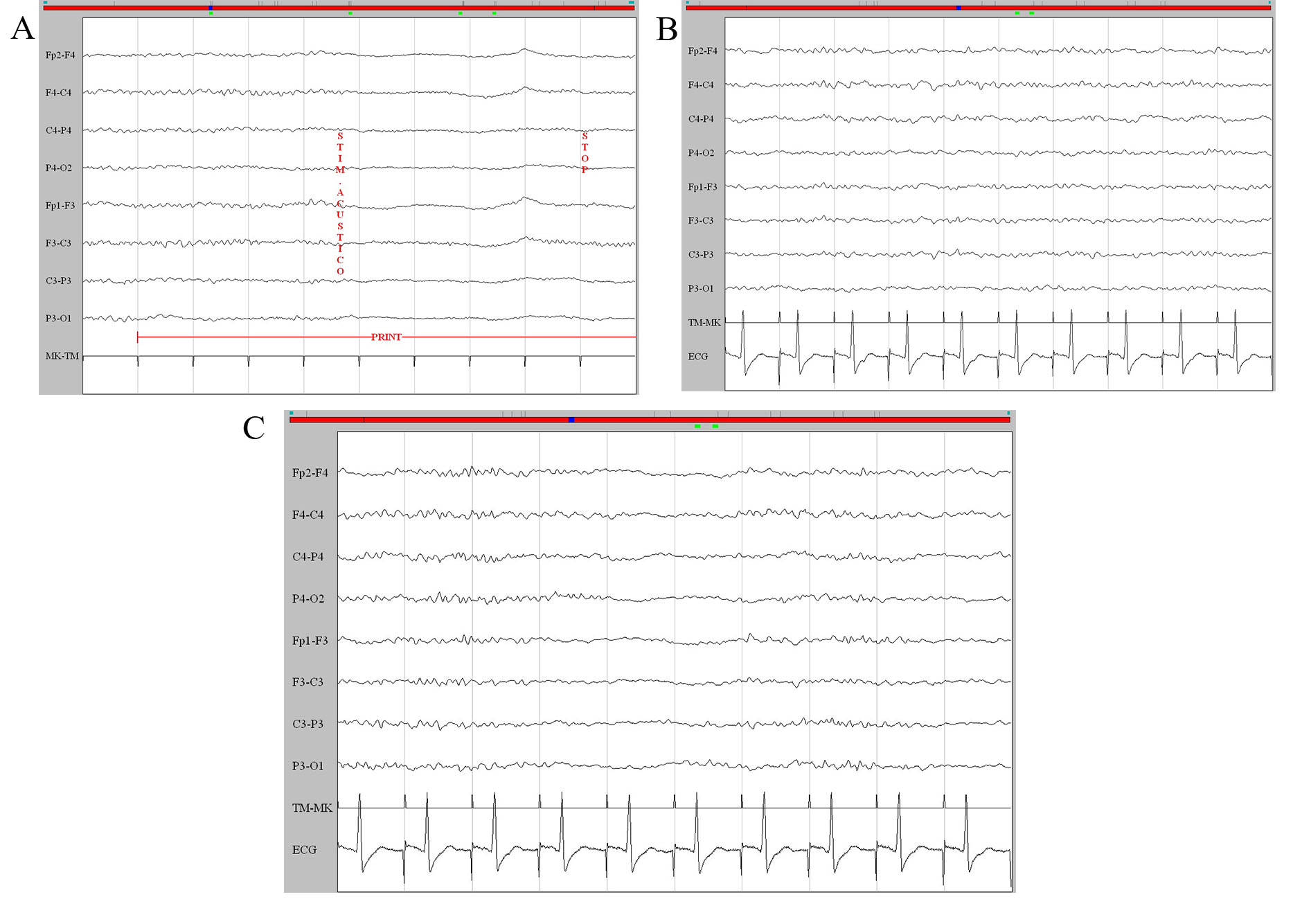 Examples of EEG patterns according to Hirsch’s classification:
benign patterns: (A) reactive background; (B) continuous; (C) nearly-continuous.
Sweep time: 1 sec/div; sensibility: 7 µV/mm.