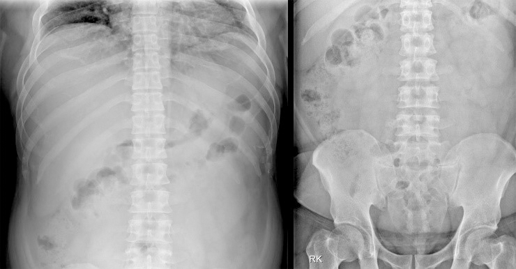 Abdominal/pelvic x-ray shows no specific
findings suggestive of acute gastroenteritis or ureter stone.