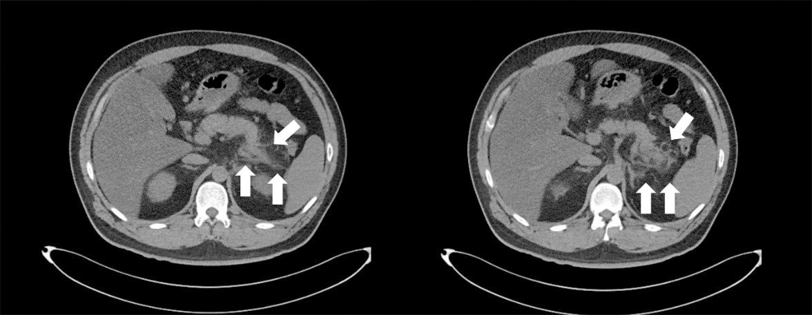 Axial abdomen/pelvic computer tomography
shows swelling of pancreatic tail portion with peripancreatic infiltration and
fluid (white arrows).