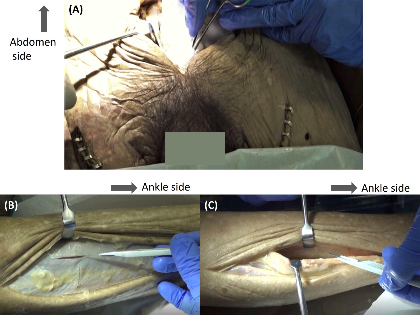 Procedure of the pelvic package and fasciotomy of the lower
extremity. (A) Procedure of the pelvic package with gauze in advanced
cadaver-based educational seminar for trauma surgery (C-BEST) using cadavers
embalmed using the saturated salt solution (SSS) method, (B) procedure of the
opening of an anterior compartment with a knife in the fasciotomy of the lower
extremity (FLE) in advanced C-BEST using cadavers embalmed using the SSS method,
(C) procedure of the opening of a deep posterior compartment with a knife in FLE
in advanced C-BEST using cadavers embalmed using the SSS method.
These pictures were taken during advanced C-BEST held in September
2015.