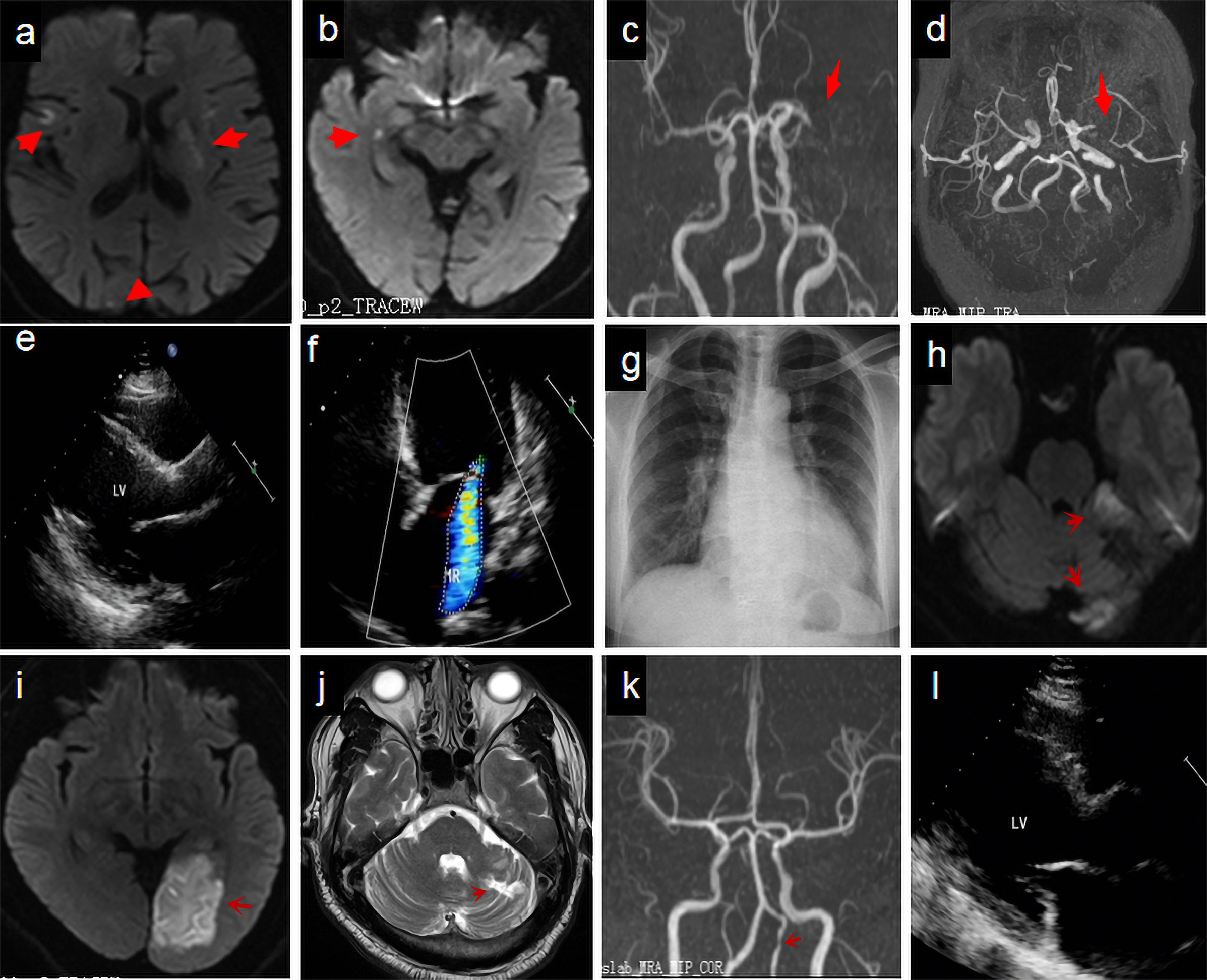Imaging and echocardiography results.Findings from Case 1. Diffusion-weighted magnetic resonance imaging showed acute
infarction lesions in the left basal ganglia, right temporal lobe, right
occipital lobe (a, arrows), and right hippocampus (b, arrow). Magnetic resonance
angiography (MRA) revealed severe stenosis or occlusion of the M2 segment of the
middle cerebral artery (arrow), with compensatory meningeal collateral
circulation (c,d). Echocardiography showed left atrial and left ventricular (LV)
enlargement (e, LV diastolic diameter, 63 cm) with moderate reflux (f). Chest
radiography showed cardiac enlargement (cardiothoracic ratio, 0.66), mainly in
the left ventricle (g).
Findings from Case 2. Diffusion-weighted sequence demonstrated
multiple acute cerebral infarctions in the left cerebellar hemisphere (h, arrows)
and left occipital lobe (i, arrow). T2-weighted sequence showed multiple
softening left cerebellar lesions (j, arrow). MRA revealed cerebral
atherosclerosis with mild left vertebral artery stenosis (k, arrow).
Color Doppler echocardiography showed left
atrial and ventricular enlargement (l, LV diastolic diameter, 60 cm).