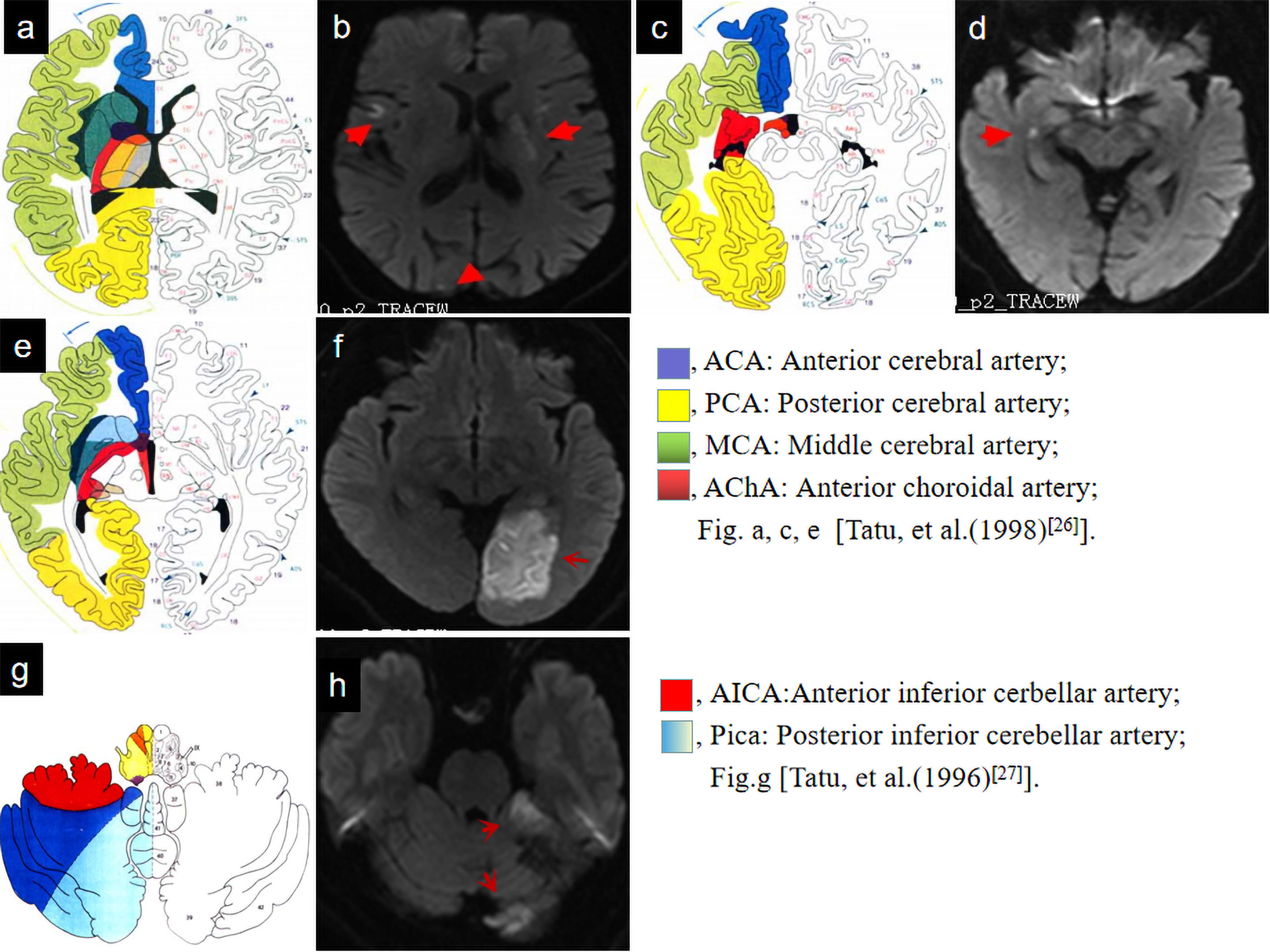 The different territories involved by acute ischemic 
stroke lesions. Fig. 2a,c,e [26], Fig. 2g [27]. 
In Case 1, multiple acute foci were supplied by the bilateral middle cerebral 
(a,b), posterior cerebral (a,b), and anterior choroidal (c,d) arteries. 
In Case 2, the acute infarction lesions were supplied by the posterior cerebral 
(e,f), and the posterior and anterior inferior cerebellar (g,h) arteries.