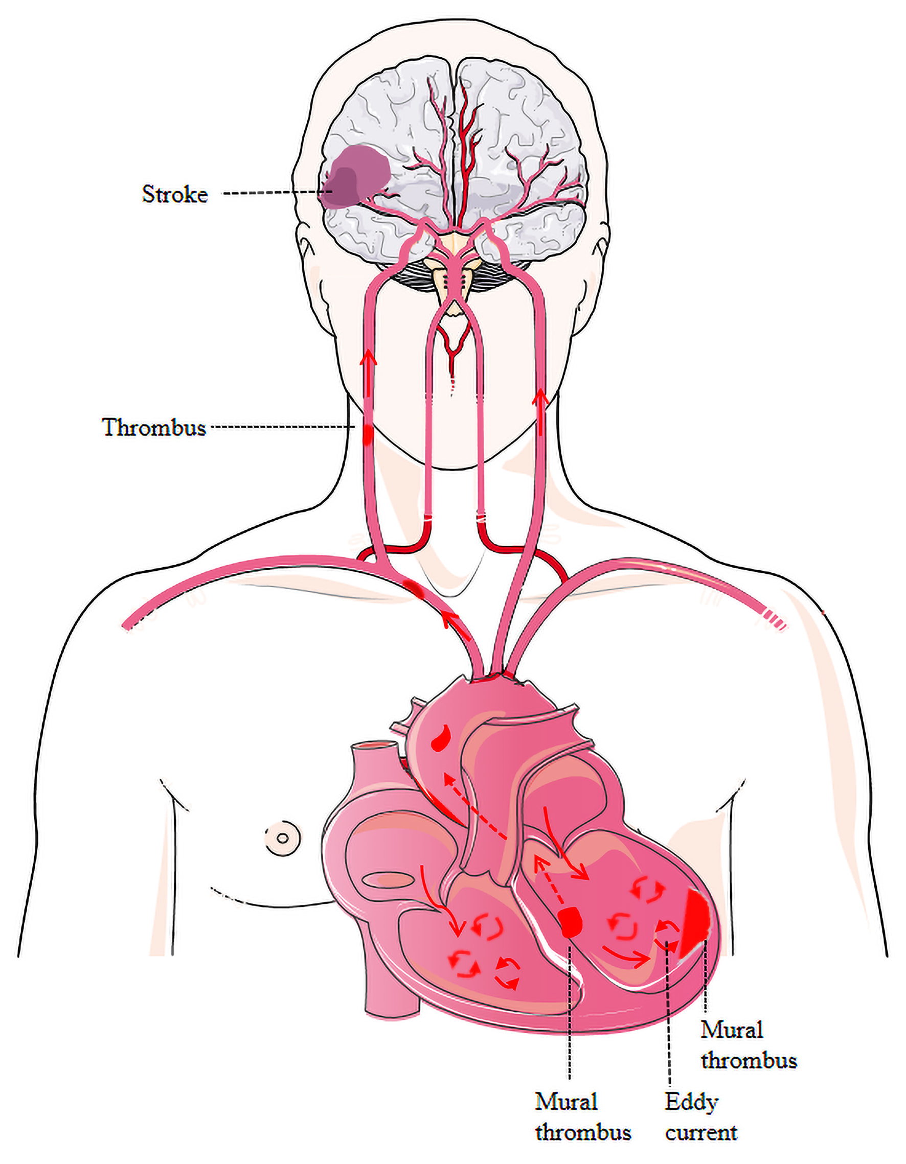 Graphical abstract.Patients with dilated cardiomyopathy can develop hemodynamic disorders, such as
eddy currents in the dilated ventricles, and hemodynamic disorders can easily
result in intracardiac mural thrombi, especially in the dilated LV. In this case,
the mural thrombus might have become dislodged and entered the systemic
circulation, resulting in a cerebral embolism.