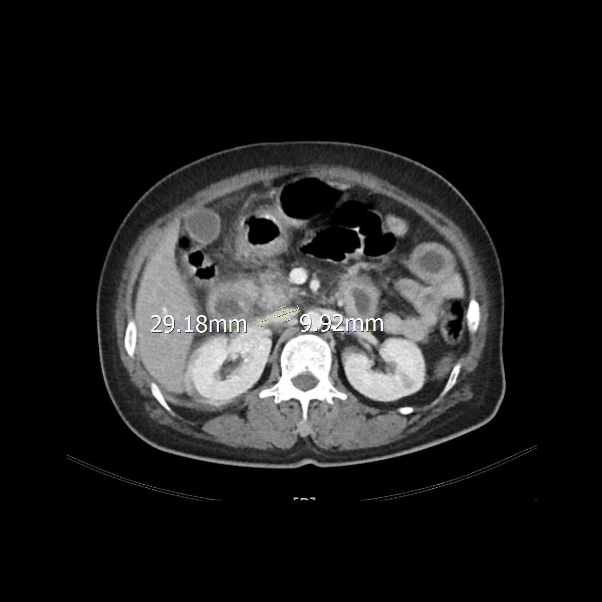 The IVC diameter ratio of 78-year-old female patient who was
expired in the emergency department was 2.94.
