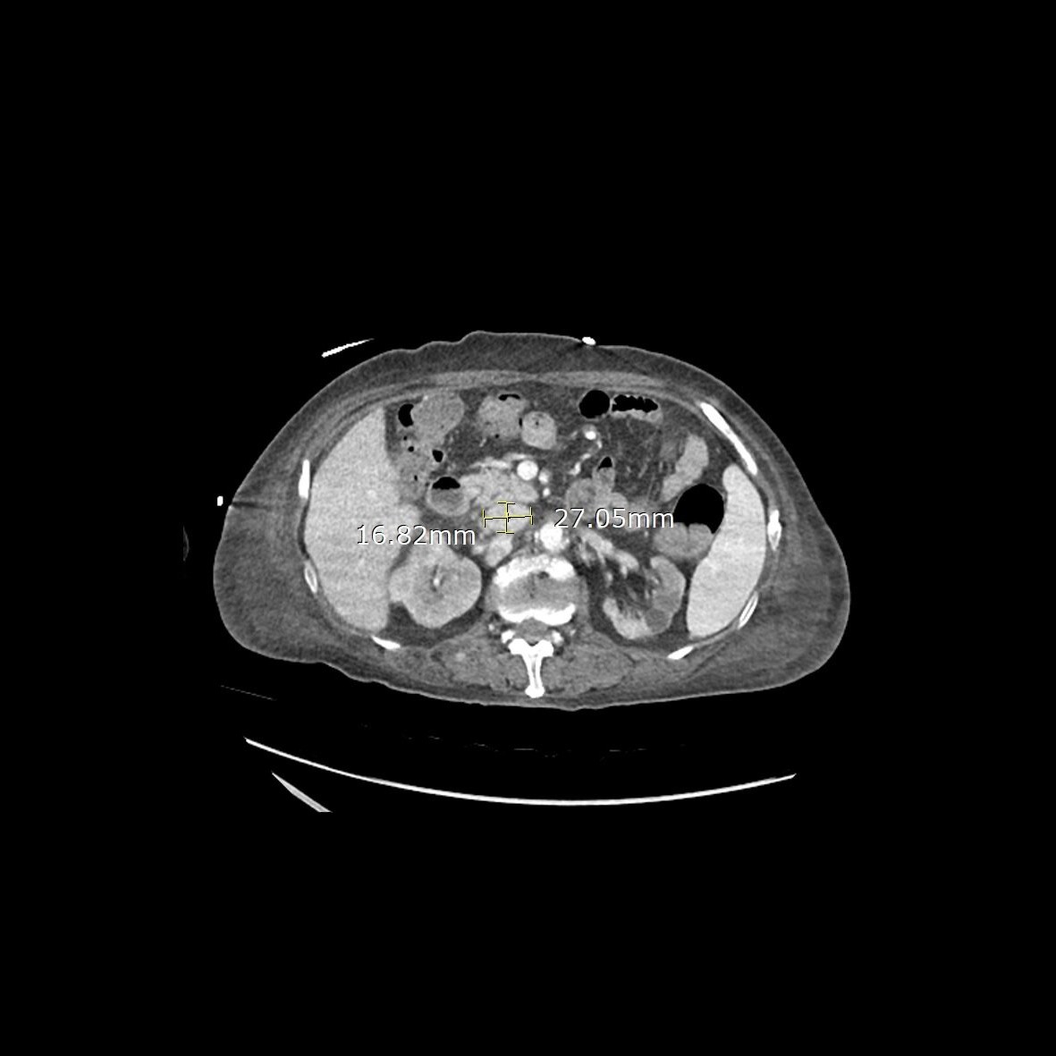 The IVC diameter ratio of 67-year-old male patient who was
survived in the emergency department was 1.61.
