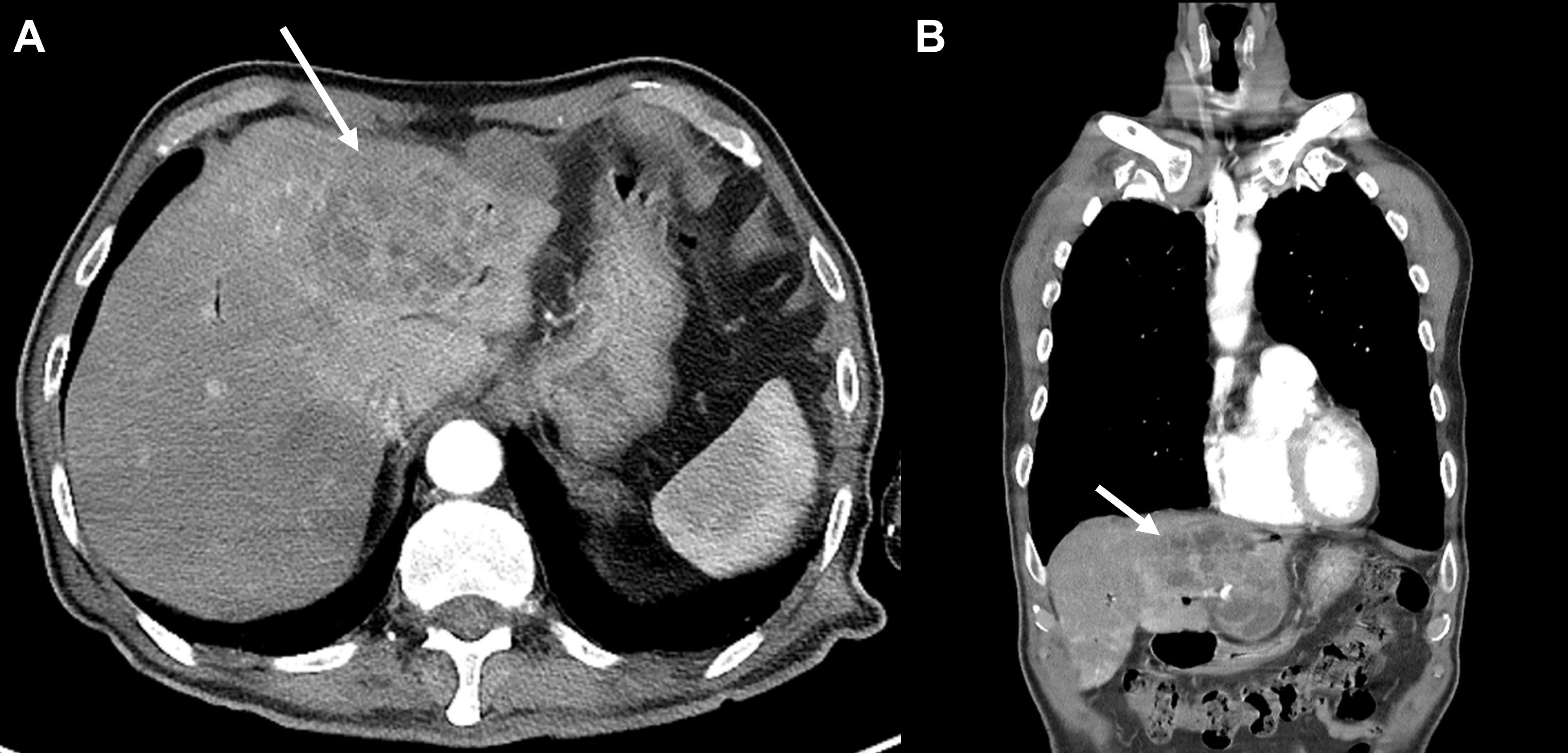 Contrast-enhanced computed tomography scan of the 8.3 cm liver
abscess in segments 2, 3, and 4. (A) Horizontal view; (B) coronal view.