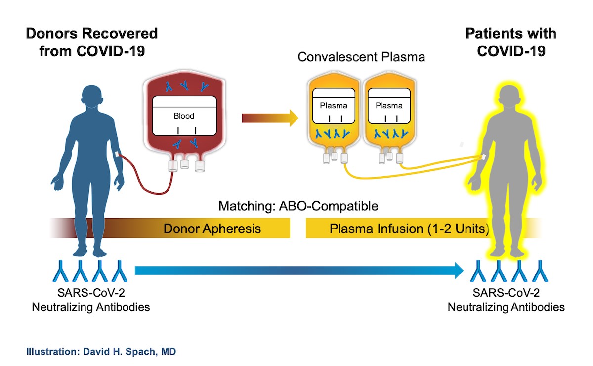 Collection and transfusion of two units of convalescent plasma.
The image was reproduced with the permission of David Spach, MD.
