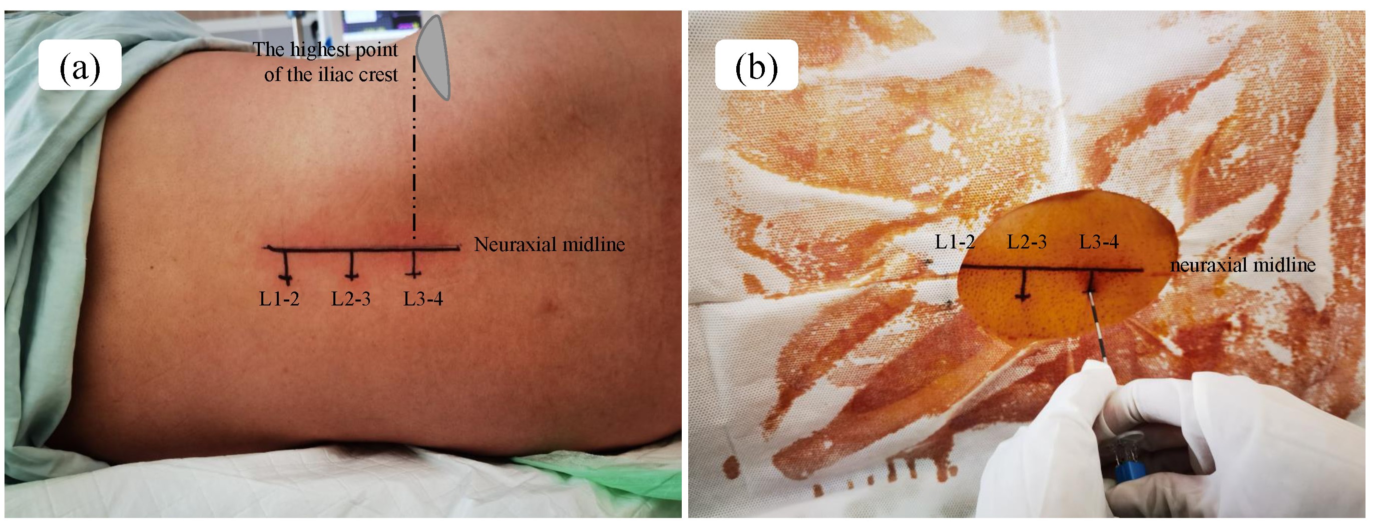Skin markings and needle insertion based on
experience. (a) Using the palpation technique to locate the intervertebral space
in the ALC group. (b) Paramedian needle insertion based on experience.