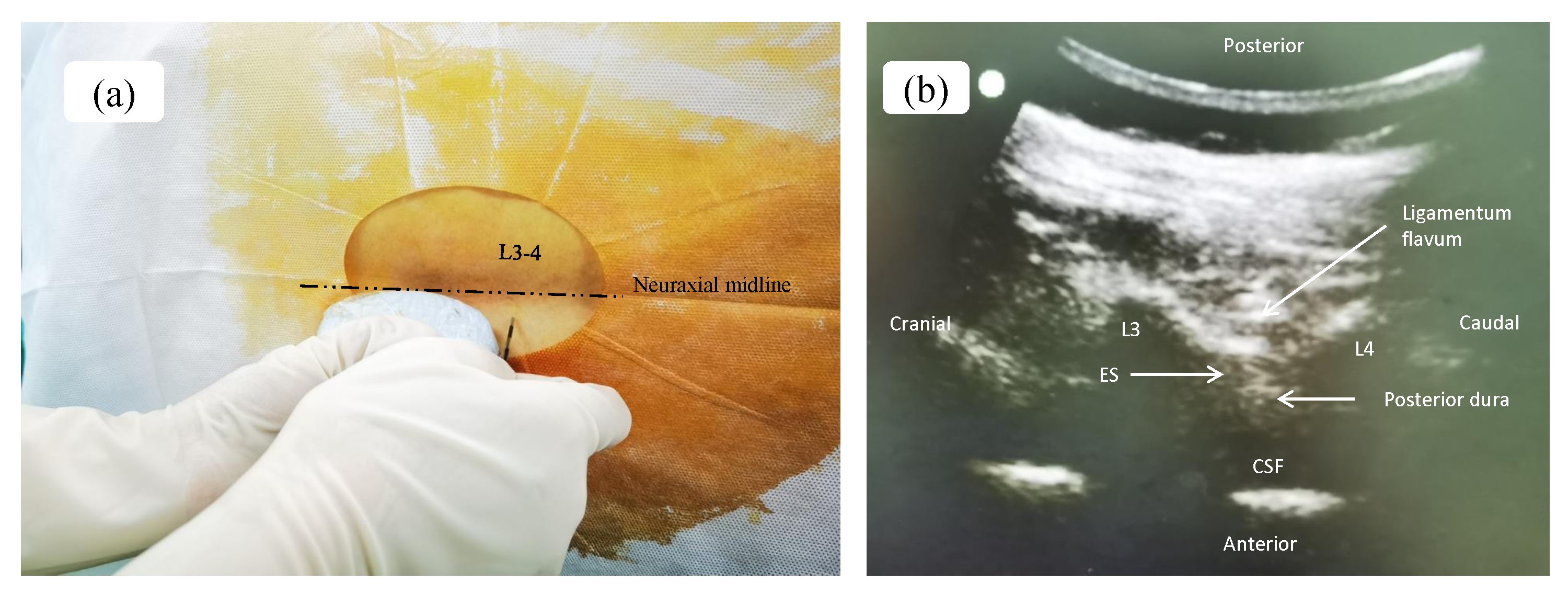 Ultrasound-guided insertion and ultrasound imaging. (a)
Ultrasound-guided paramedian epidural anesthesia. (b) Paramedian sagittal view.
ES, epidural space; CSF, cerebrospinal fluid.