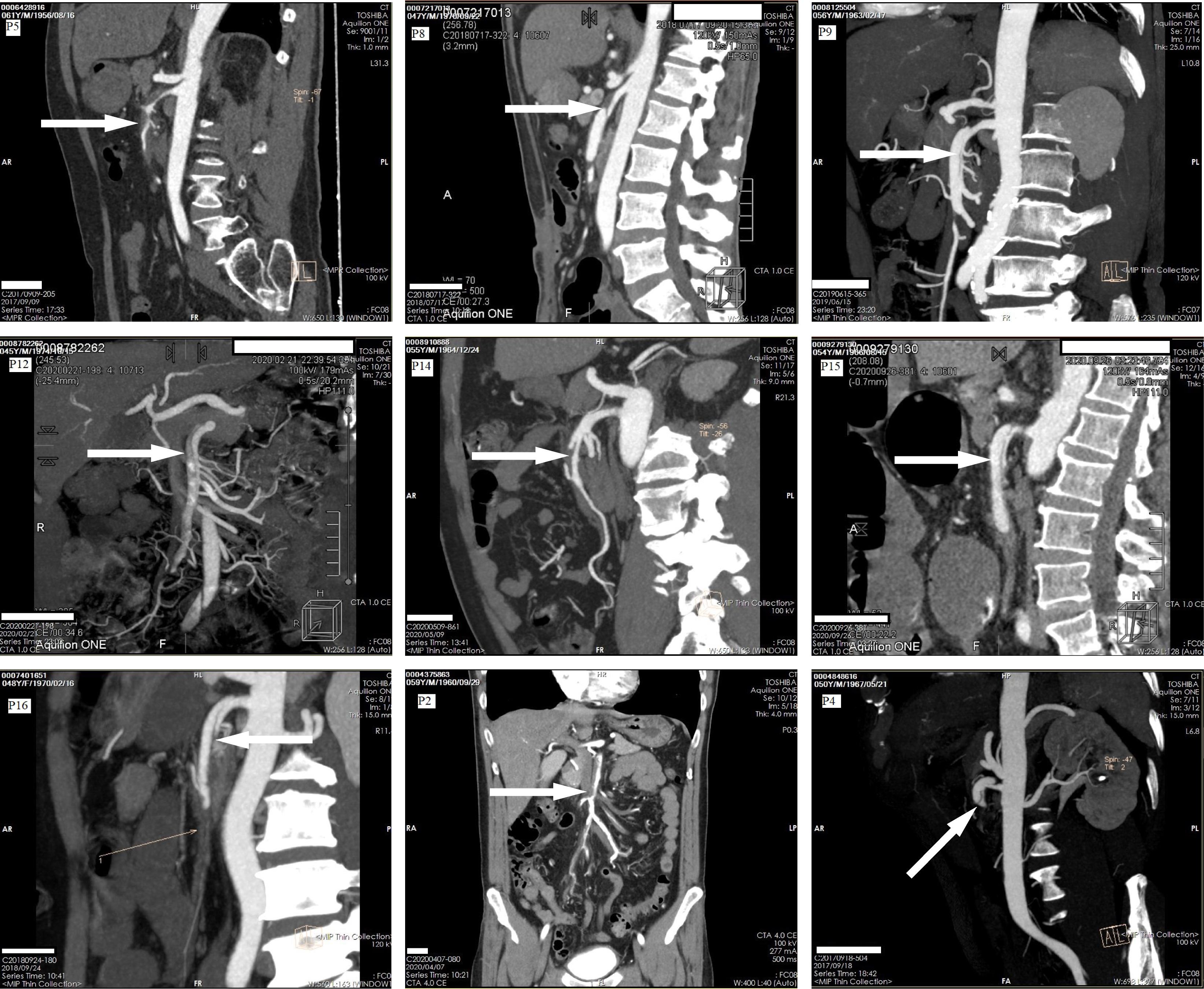An example of a dissection of the superior mesenteric artery as indicated
by the arrows, shown in a computed tomography angiography.