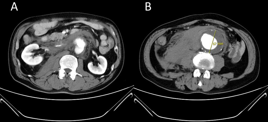 Preoperative computed tomography showing an atherosclerotic
abdominal aortic aneurysm. (A) Focal contrast extravasation along the lower
abdominal aorta. (B) Atherosclerotic abdominal aortic aneurysm with large mural
thrombus (anteroposterior diameter: about 6.7 cm).