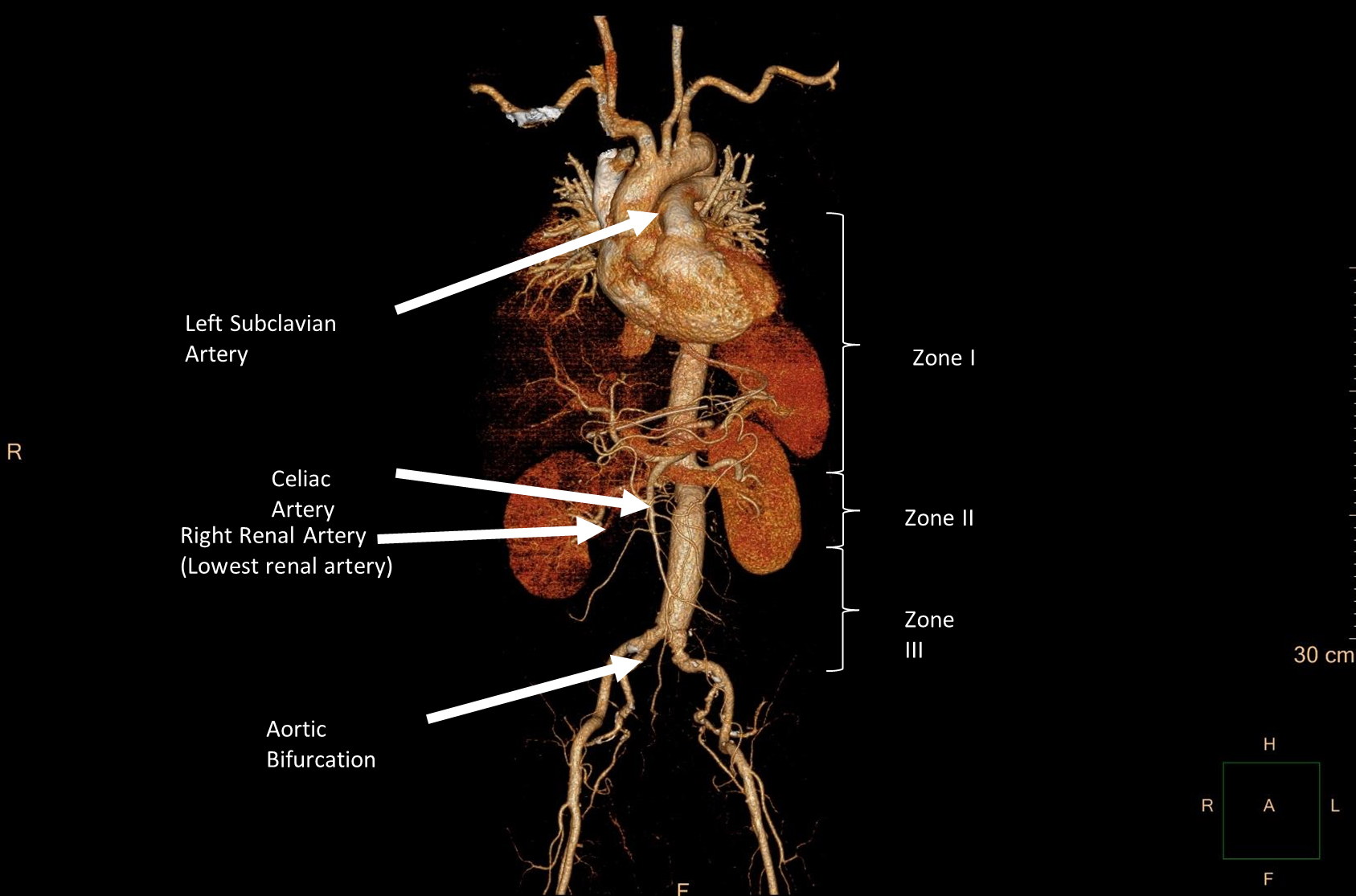 Aortic zones of occlusion (Computed Tomography Angiography of 
the patient). Zone I: the left subclavian artery to the celiac artery; Zone II: 
the celiac artery to the renal artery; Zone III: lowest renal artery to the 
aortic bifurcation cit [8].
