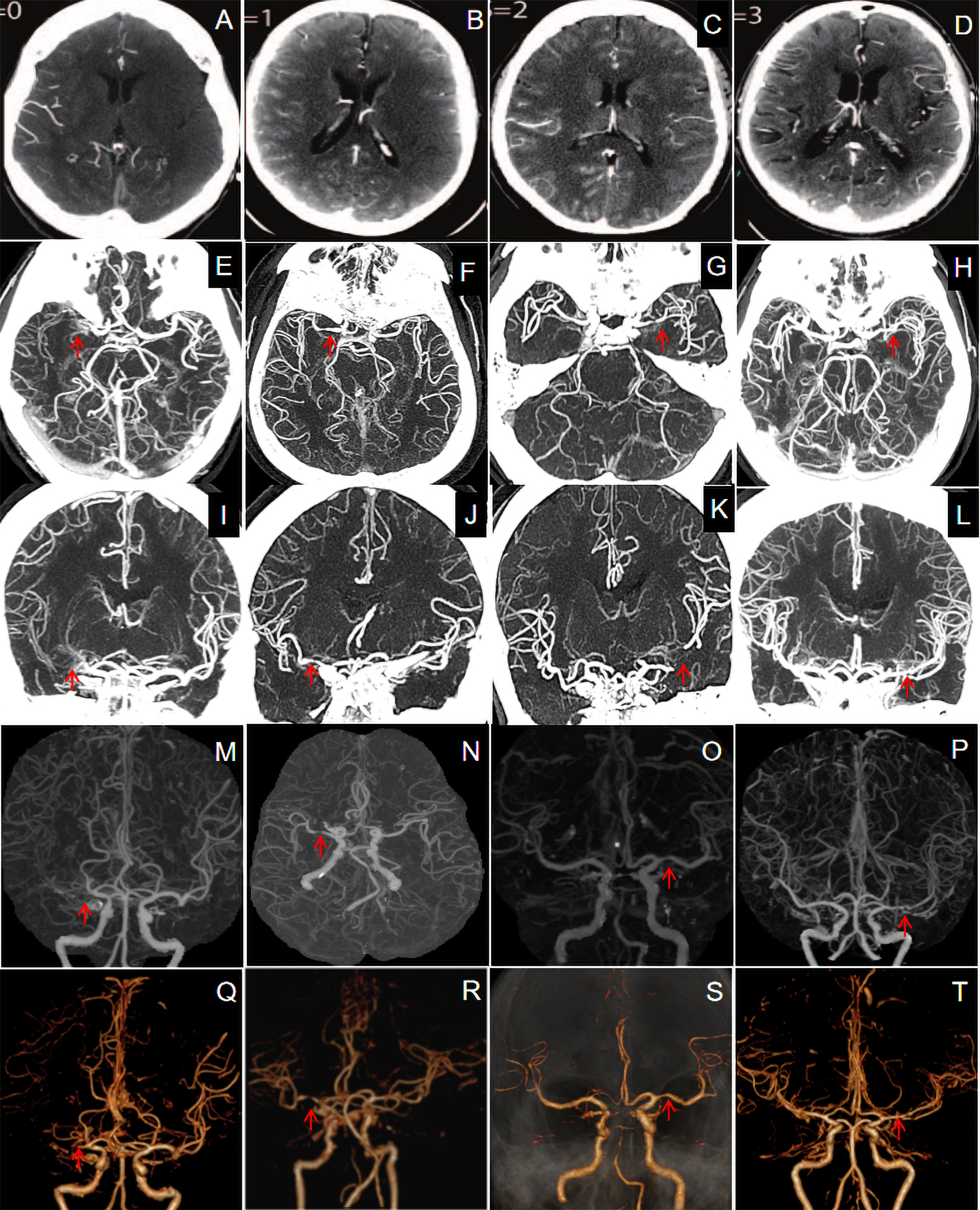 Leptomeningeal collateral (LMC) status score assessed using 
enhanced computed tomography based on the Tan score system: (A) 
0 point; (B) 1 point; (C) 2 points; (D) 3 points [12]. LMC status assessed using 
axial (E–H) and coronal (I–L) maximal intensity projection 
(MIP) corresponds to the Tan score system; LMC status assessed 
using three dimensional MIP (M–P) and 
multi-plane volume reconstruction (Q–T) 
corresponds to the Tan score system. The red arrows all point to the middle 
cerebral artery stenosis.