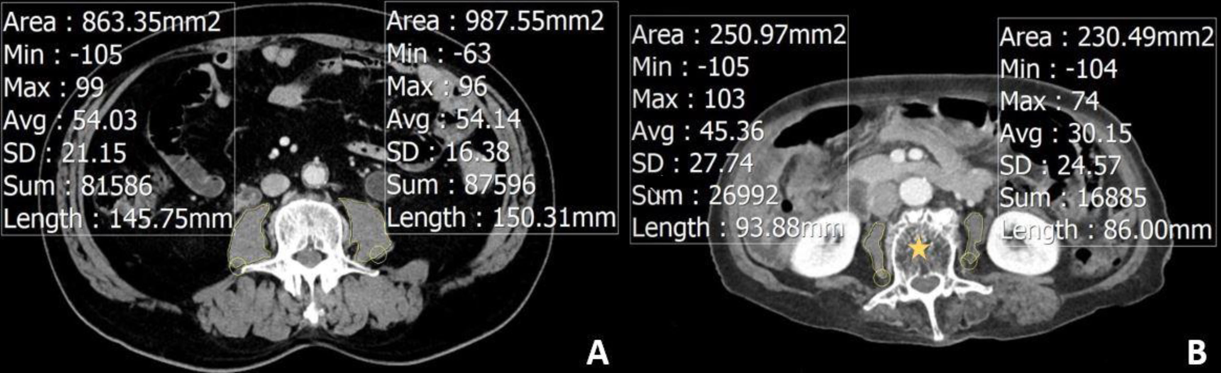 Axial abdominal and pelvic CT images outlining the psoas muscles
bilaterally were obtained at L3 level in two different patients (yellow stars).
(A) 69-year-old man, image presents a cross-sectional area (yellow outline)
measuring left side and right side which were 987.55 mm2 and 863.35 mm2
and mean attenuation measuring left side and right side which were 54.14 HU (SD:
16.38) and 54.03 HU (SD: 21.15), respectively. (B) 77-year-old woman, image
presents a cross-sectional area (yellow outline) measuring left side and right
side which were 230.49 mm2 and 250.97 mm2 and mean attenuation
measuring left side and right side which were 30.15 HU (SD: 24.57) and 45.36 HU
(SD: 27.74), respectively.
