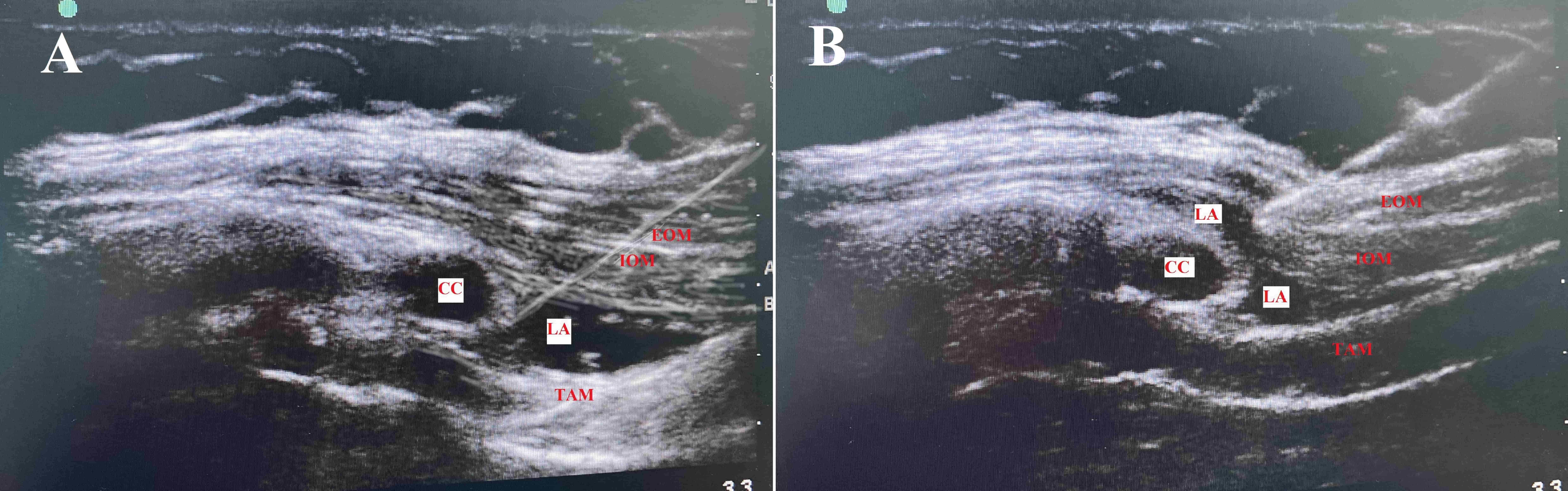 Ultrasonographic image of TAPA and m-TAPA blocks. m-TAPA (A) and
TAPA (B) ultrasound image of the perichondral region after local anesthetic
solution was injected. CC, costal cartilage; EOM, external oblique muscle; IOM,
internal oblique muscle; TAM, transversusabdominis muscle; LA, local anesthetic.