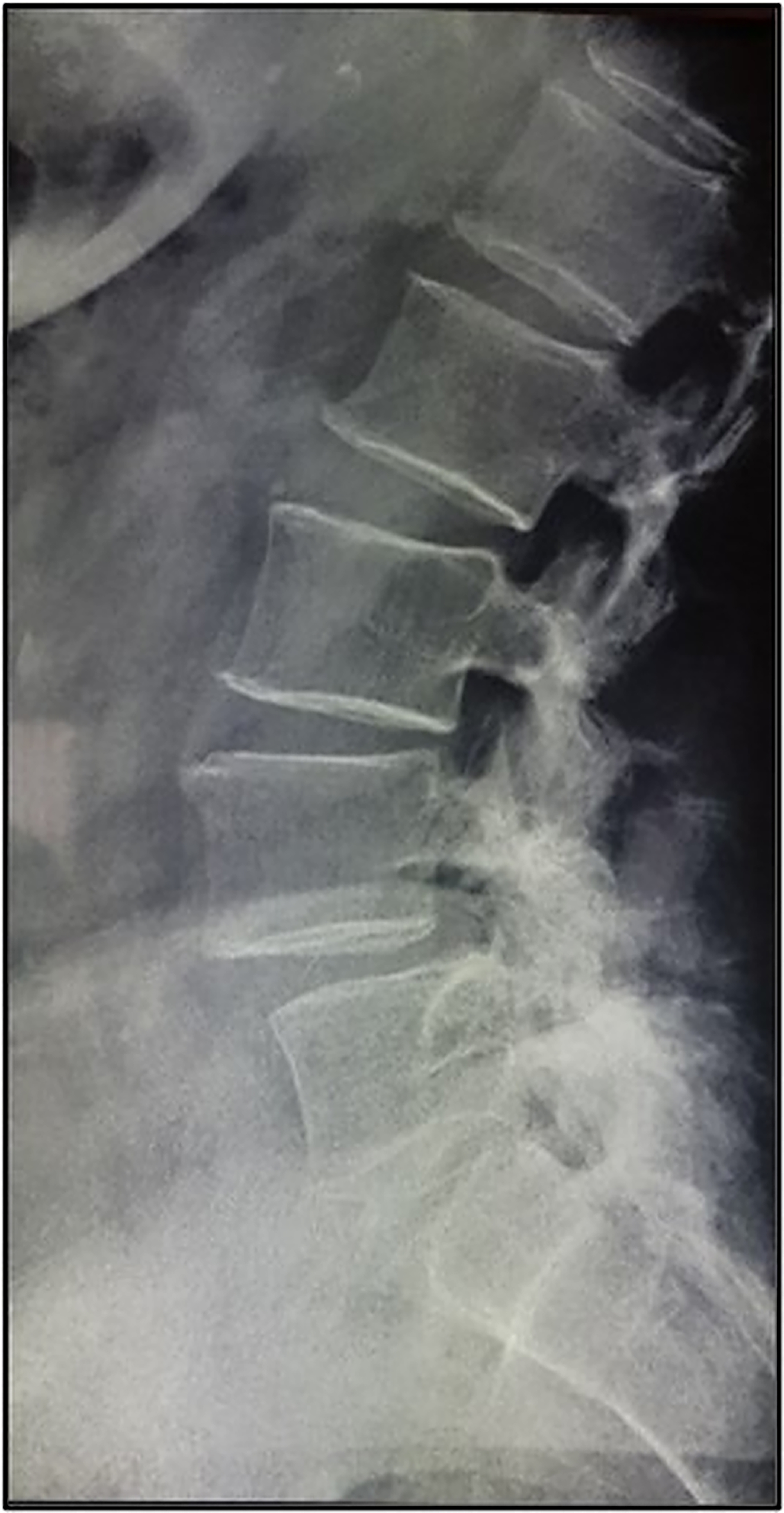Lumbar spine-lateral incidence. 7 mm DS L4–L5 with the thought
of the disk space. Mild lumbar scoliosis. Accentuation of lumbar lordosis.
Posterior interopophyseal osteoarthritis L4–L5, L5–S1.