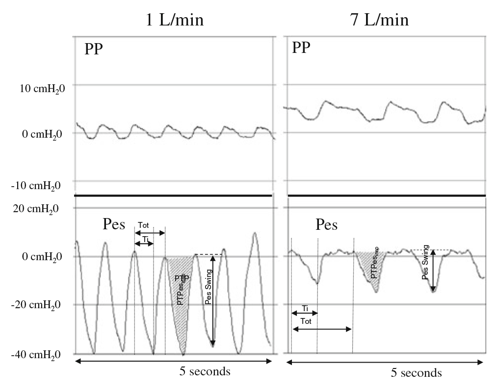 Simultaneous recording of the pharyngeal pressure (PP) in the 
upper part, and the esophageal pressure (Pes) in the lower part, at 1 and 7 L/min 
in an infant. From the Pes trace, Pes swing was measured as the maximal 
variation in esophageal pressure generated by an inspiration, and pressure-time 
product (PTPesinsp) as the area under the pressure-time curve during 
inspiratory effort. Inspiratory (Ti), expiratory times, and the ratio of the 
inspiratory time to the total time of the breathing cycle (Ti/Ttot) was 
also determined from the Pes traces. The maximal flow, delivered by the nasal 
cannula, resulted in positive PP values during both inspiration and expiration 
and a dramatic decrease in Pes swings. Adapted from reference [40].
