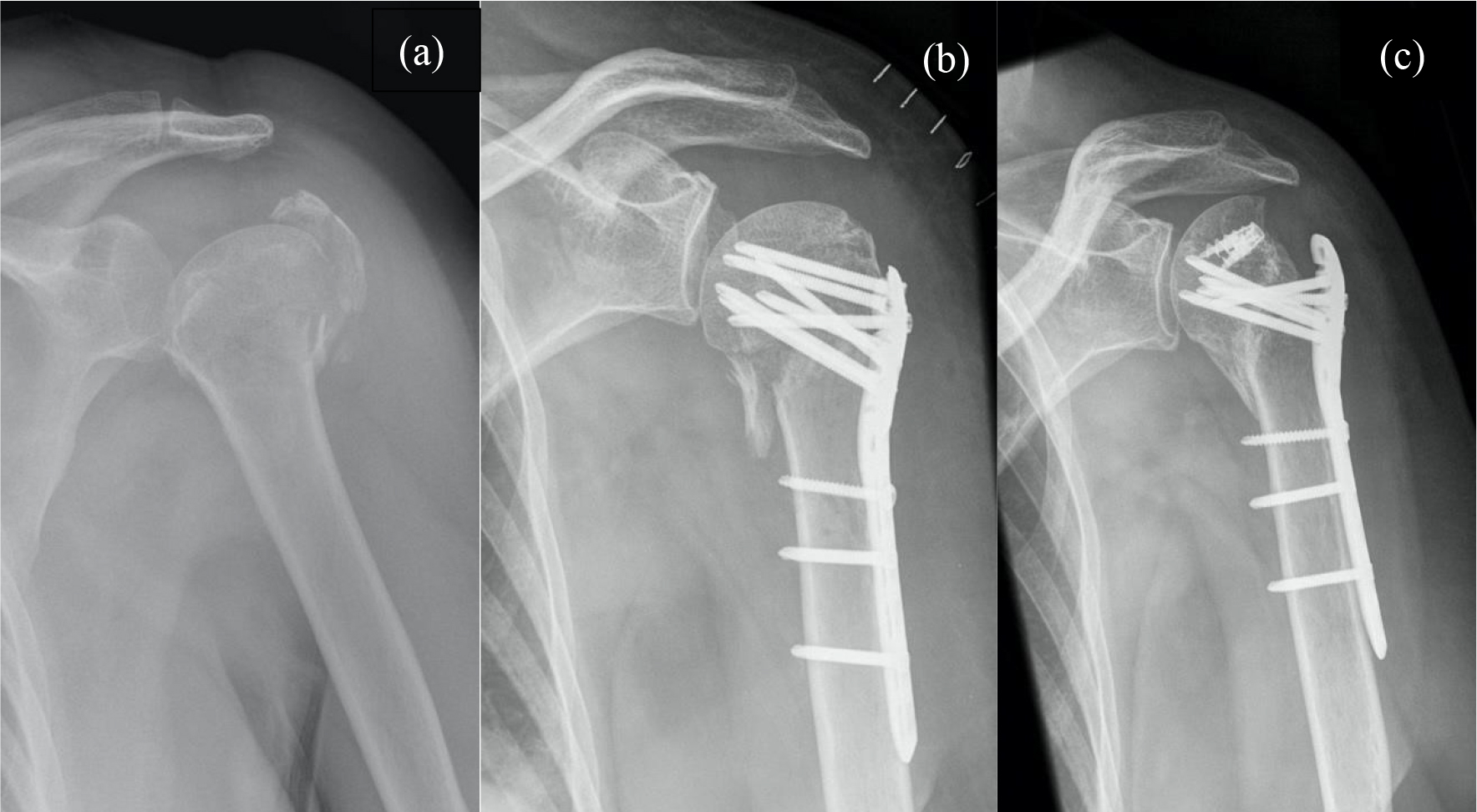 Proximal humerus surgical neck valgus
fracture and a greater tuberosity fracture (3-part fracture). (a)—fracture
x-ray on the day of the injury, (b)—open reduction and fixation with locking
plate, (c)—revision surgery—removal of proximal locking screws and fixation
of rotator cuff tendons with suture anchors, after a complete resorption of the
greater tuberosity (right).