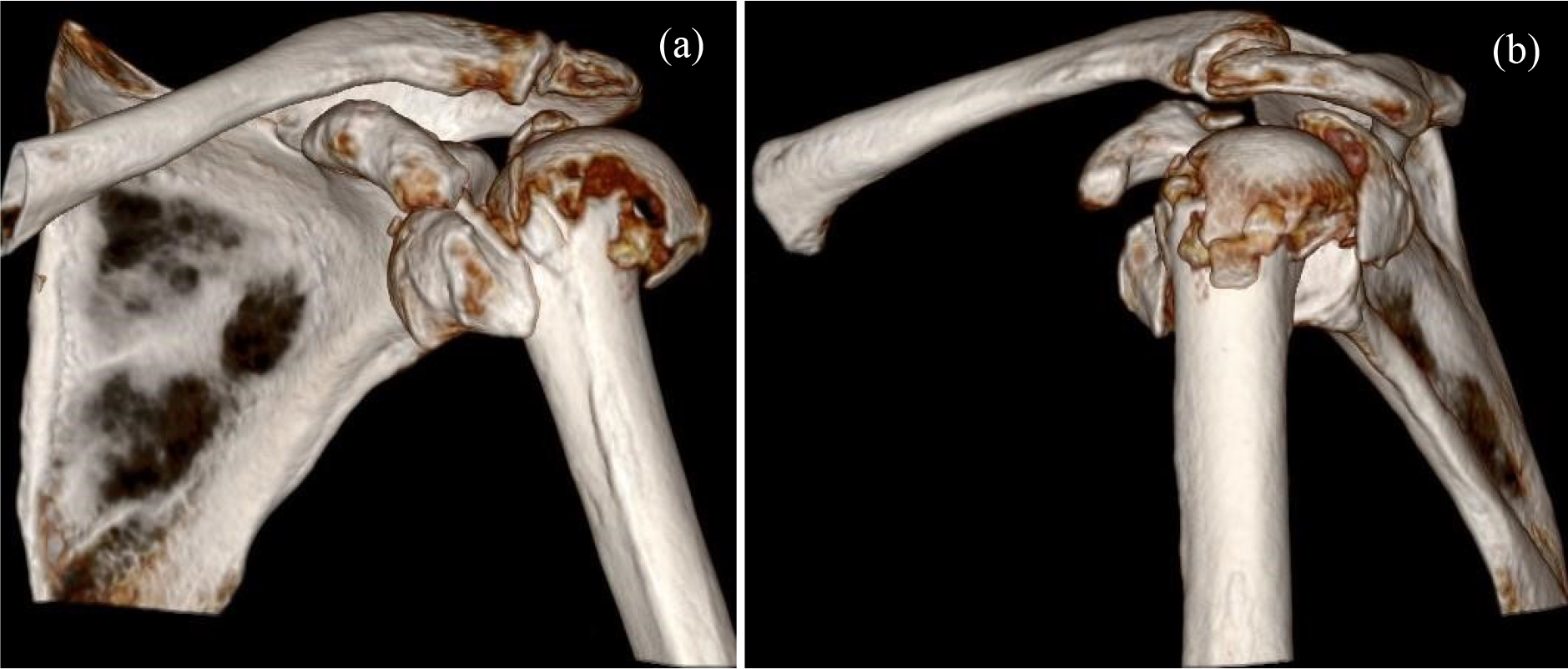 3D CT scan of a displaced 4-part
valgus proximal humerus fracture. (a)—coronar view of left shoulder,
(b)—sagittal view of left shoulder (same patient as in Fig. 3, right picture,
reversed shoulder arthroplasty (RSA)—refer to Fig. 3).