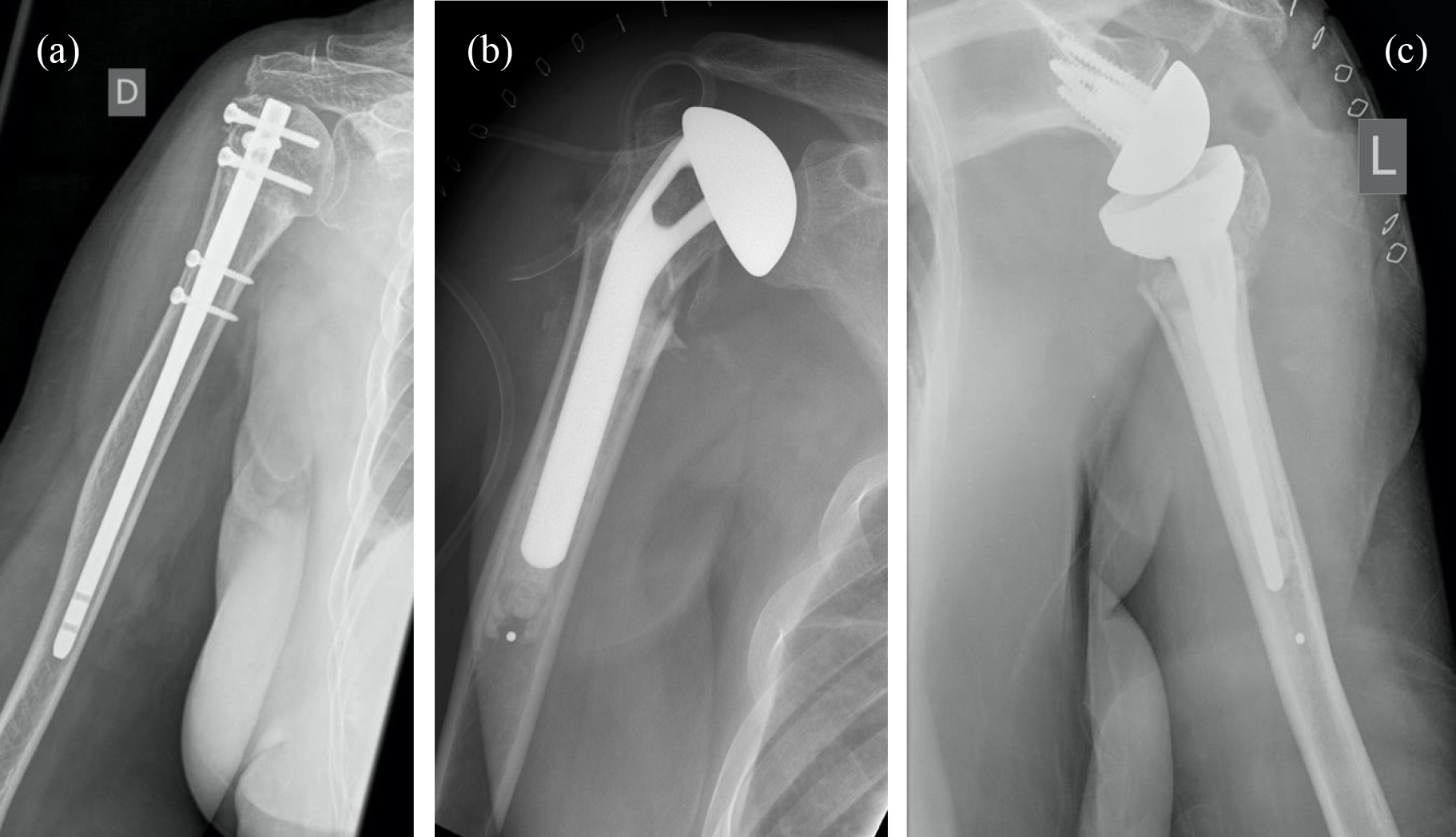 Types of surgical intervention. (a)—intramedullary nail fixation, (b)—partial fracture endoprosthesis,
(c)—reversed shoulder endoprosthesis. Fixation of a 3-part fracture with
intramedullary nail (left), implantation of partial endoprosthesis (PEP) after a
4-part fracture (middle), RSA after a 4-part fracture (right).