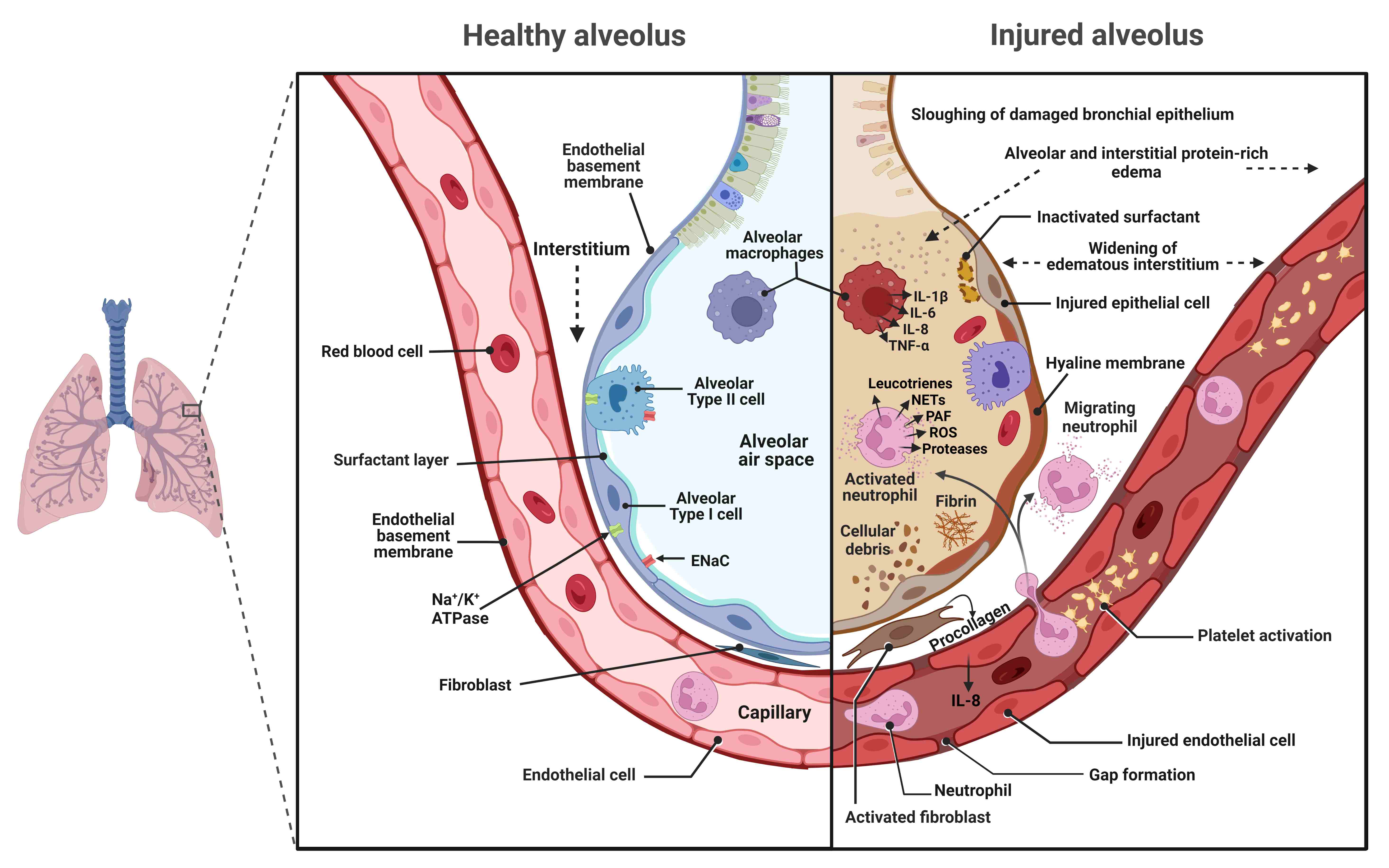 Characteristics of diffuse alveolar
damage (DAD). The acute phase of DAD is characterized by alveolar epithelial and
endothelial cell damage, an early increased permeability of the
alveolar-capillary membrane, and flooding the
airspace with protein-rich pulmonary edema fluid. Activation of resident alveolar
macrophages and enhanced neutrophil migration and activation provide host
defense, but they also release pro-inflammatory chemokines, cytokines, and other
products (proteases, ROS, NETs) that can be deleterious. Platelet activation and
release of vasoactive-procoagulant products lead to thrombi formation in the
microvasculature and fibrin deposition in the alveolar airspaces, which
contributes to the formation of hyaline membrane (mainly formed by deposition
of proteins, fibrin, and cellular debris) on the denuded epithelial membrane.
Activation of fibroblast leads to collagen deposition in the interstitium. Also,
alveolar hemorrhage can occur, and the extravasated red blood cells can release
cell-free hemoglobin, exacerbating injury via oxidant-dependent mechanisms.
Figure created with BioRender.com. Na+/K+-ATPase, sodium/potassium adenosine
triphosphatase; ROS, reactive oxygen species; NETs, neutrophil extracellular
traps; PAF, platelet-activating factor; IL, interleukin; TNF, tumor necrosis
factor.