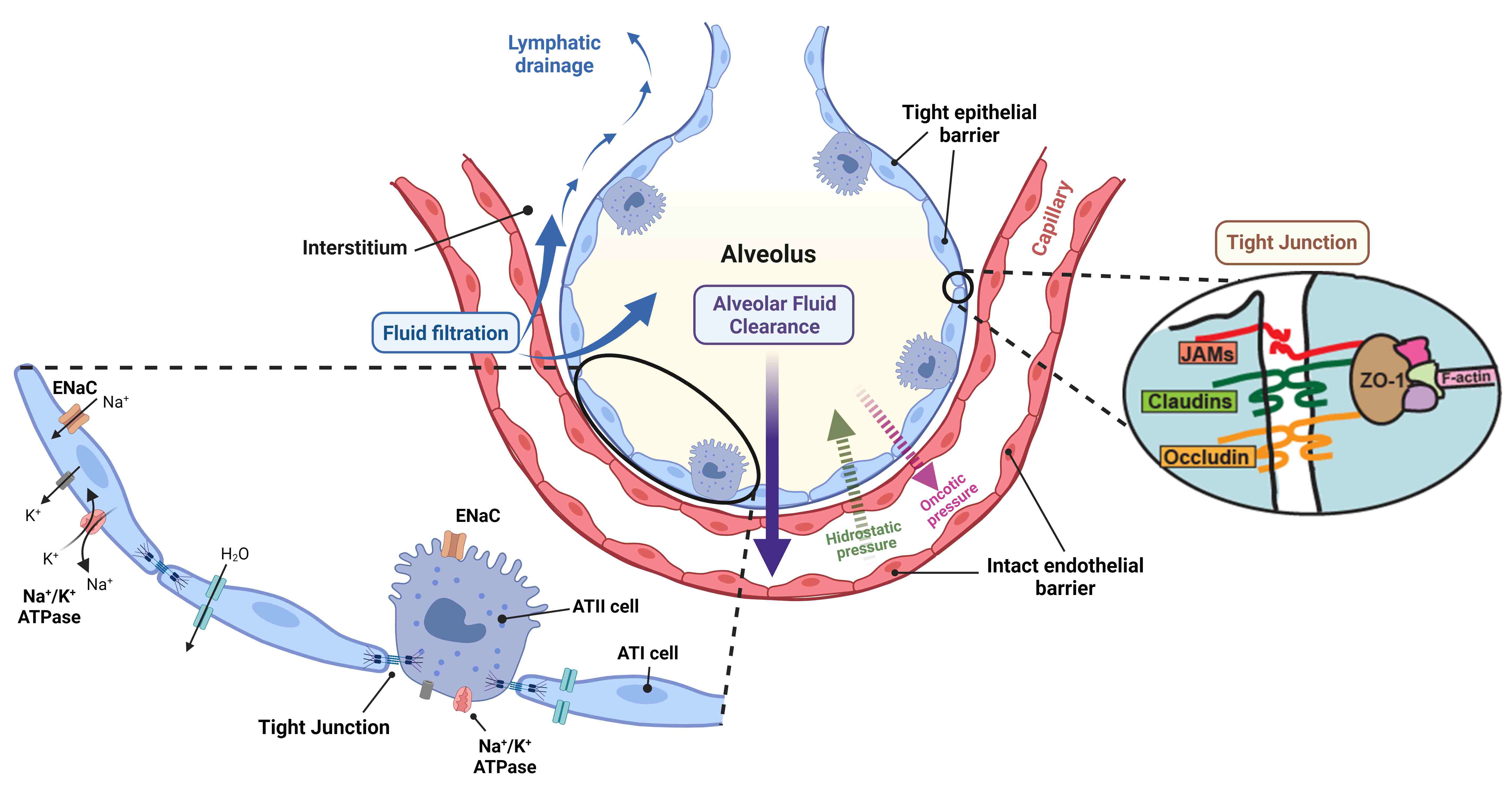 Role of alveolar epithelium in lung
edema. The alveolar epithelium is a continuous and tight monolayer of alveolar
type I (ATI) and alveolar type II (ATII) cells. ATI cells are very thin and
permit gas exchange, and ATII cells produce surfactant to enable lung expansion
with low surface tension. The intact alveolar epithelium is linked by
intercellular tight junctions that restrict the passage of water, electrolytes,
and small hydrophilic solutes to the airspaces. In the normal lung, the
transvascular flux of fluid out of the capillary moves water and
low-molecular-weight solutes into the interstitial space depending on the
permeability of the capillary membrane and the net difference between hydrostatic
and protein osmotic pressure. In health, this fluid does not cross the epithelial
barrier and moves into the lymphatics. When alveolar edema occurs, this edema
fluid accumulating in airspaces is absorbed by the epithelium following a
transepithelial osmotic gradient created by an active sodium transport. This
sodium gradient is created and maintained by the apical membrane epithelial
Na+ channels (ENaC) and the basolateral sodium/potassium adenosine
triphosphatase (Na+/K+-ATPase) in both ATI and ATII cells, causing
excess water to move passively from the airspaces to the interstitium. Figure
created with BioRender.com. JAMs, junctional adhesion molecules; ZO-1, Zonula
occludens-1.