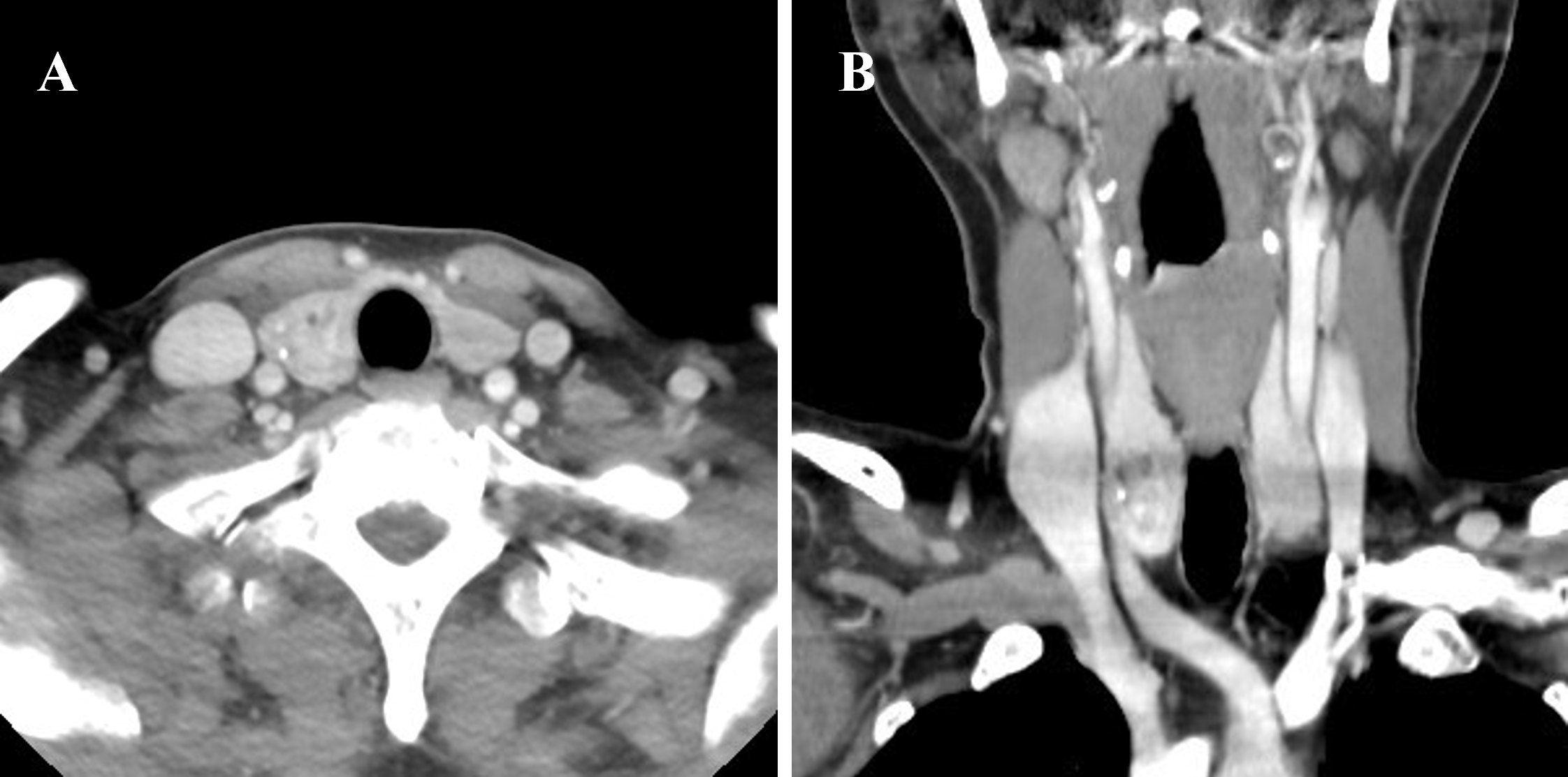 Computed 
tomography of the neck showing a solid nodule of approximately 3 cm in size in 
the right lobe and a few small solid nodules in the left lobe of the thyroid 
gland. (A) Axial view; (B) coronal view.