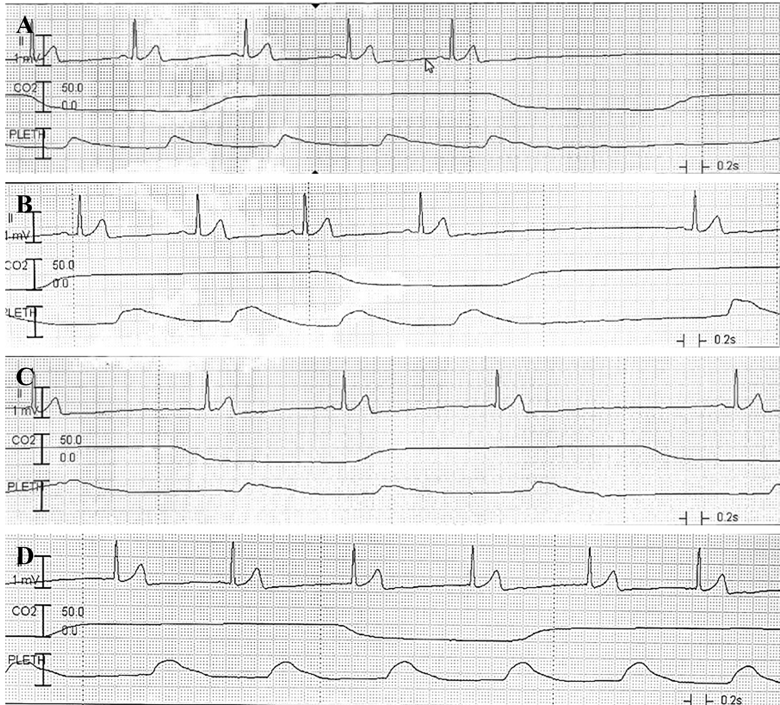 Telemetry electrocardiogram 
(top) and plethysmography (bottom) demonstrating multiple sinus pauses during 
suspension laryngoscopy for the laryngeal microsurgery. (A) A sinus pause was 
detected for approximately 5 s when external laryngeal manipulation (ELM) was 
applied. (B) The heart rate was restored as the ELM was discontinued. (C) When 
adjusting the neck position and applying the ELM, several sinus pauses recurred 
following the initial 3.5 s sinus pause. (D) After good laryngeal visualization 
was achieved and the ELM was no longer required, the heart rate returned to the 
normal range. PLETH: Plethysmography.
