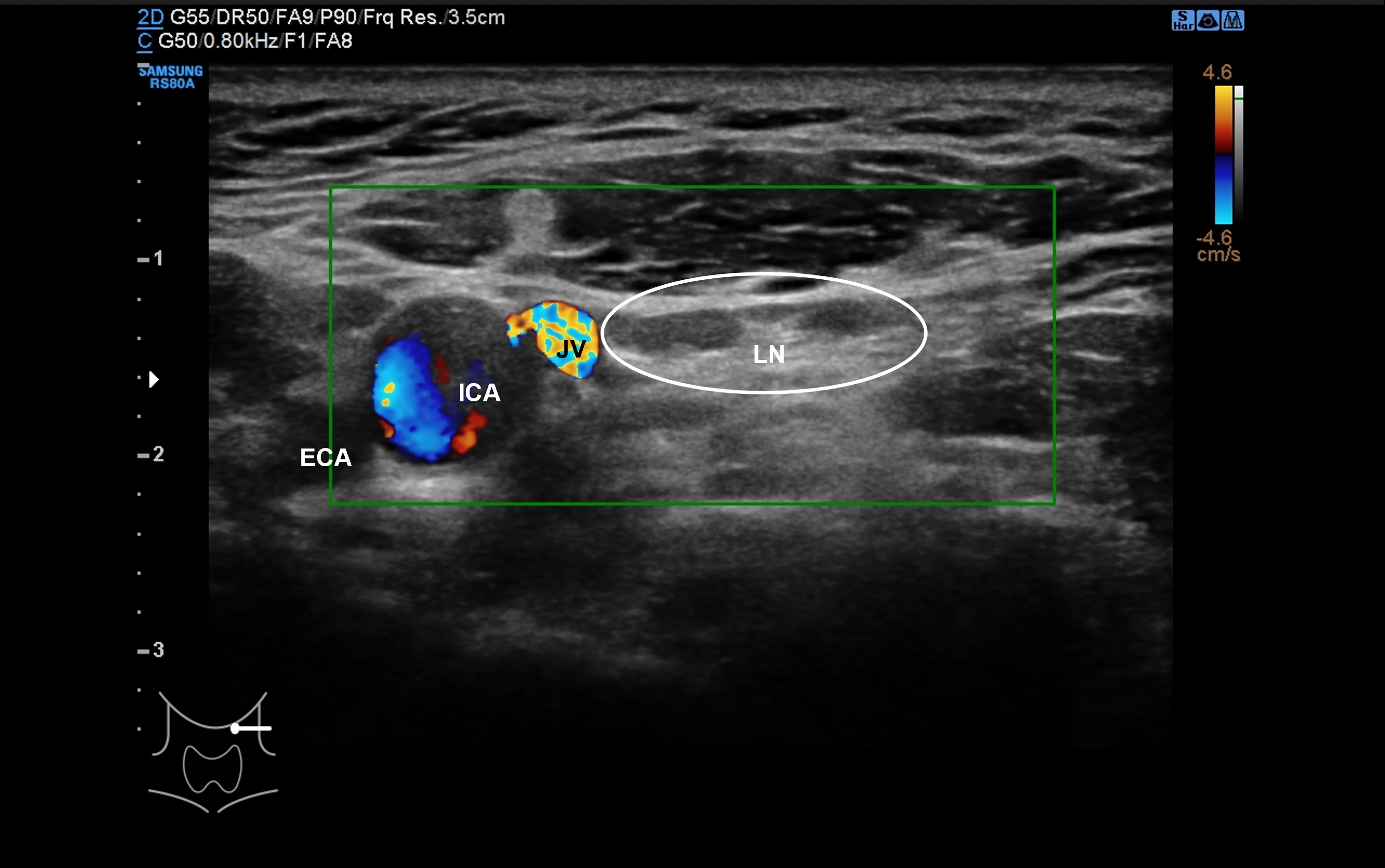 Preoperative ultrasound of 
the left side of the neck showing enlarged lymph nodes in level II. ECA: 
external carotid artery; ICA: internal carotid artery; JV: jugular vein; LN: 
lymph node.