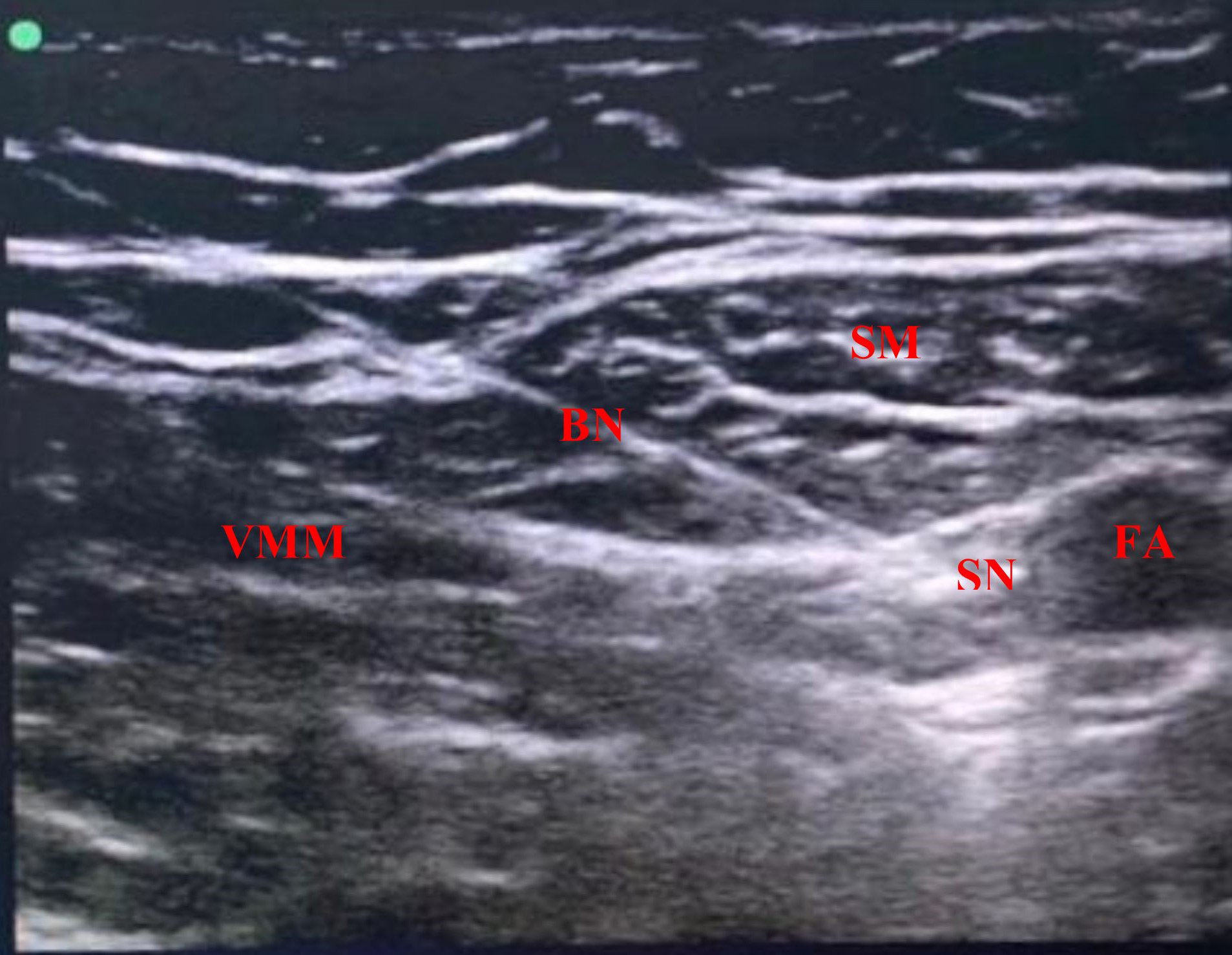 Adductor Canal Block; Ultrasound Anatomy. BN, block needle; SN, 
saphenous nerve; FA, femoral artery; SM, sartorius muscle; VMM, vastus medialis 
muscle.