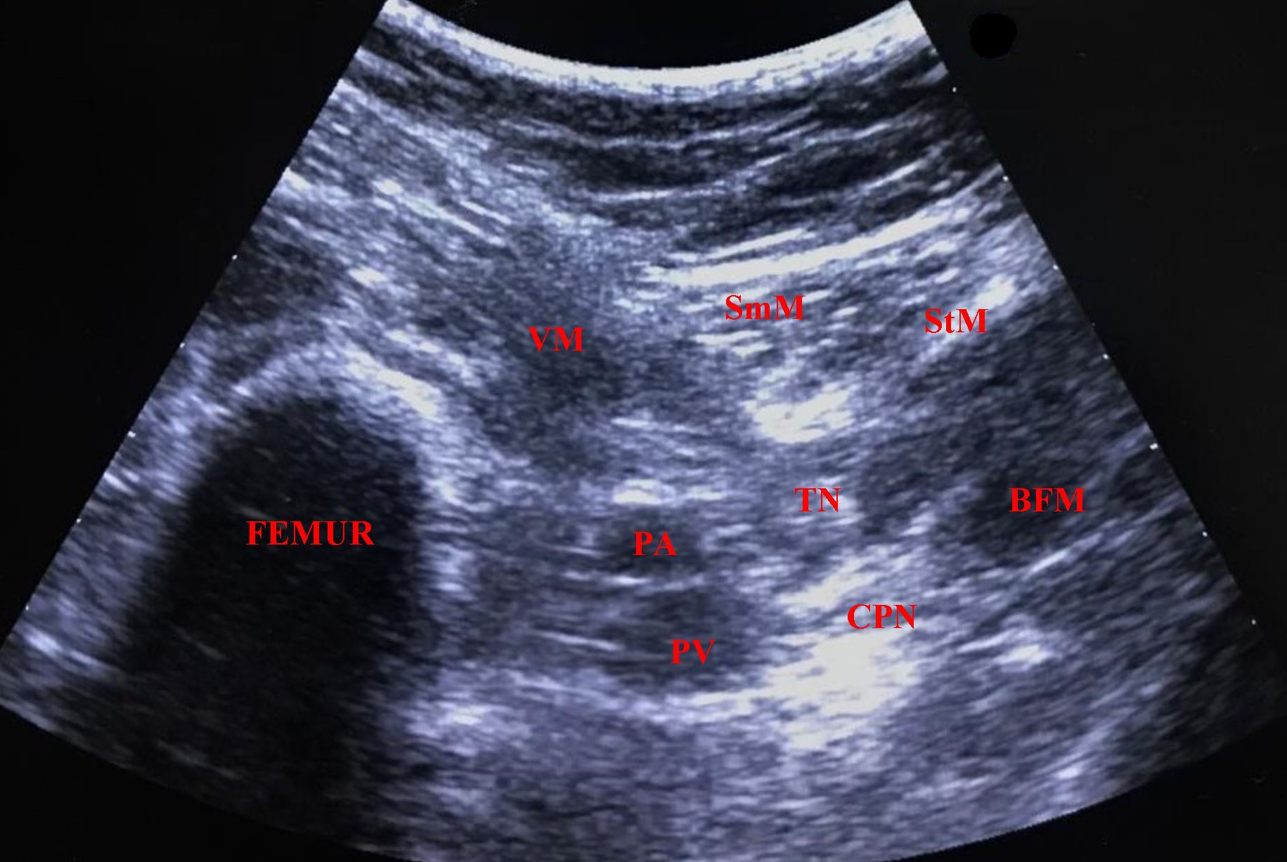 IPACK block; Reverse Ultrasound Anatomy. SmM, semimembranosus 
muscle; StM, semitendinosus muscle; VMM, vastus medialis muscle; BFM, biceps 
femoris muscle; PA, popliteal artery; PV, popliteal vein; TN, tibial nerve; CPN, 
common peroneal nerve.