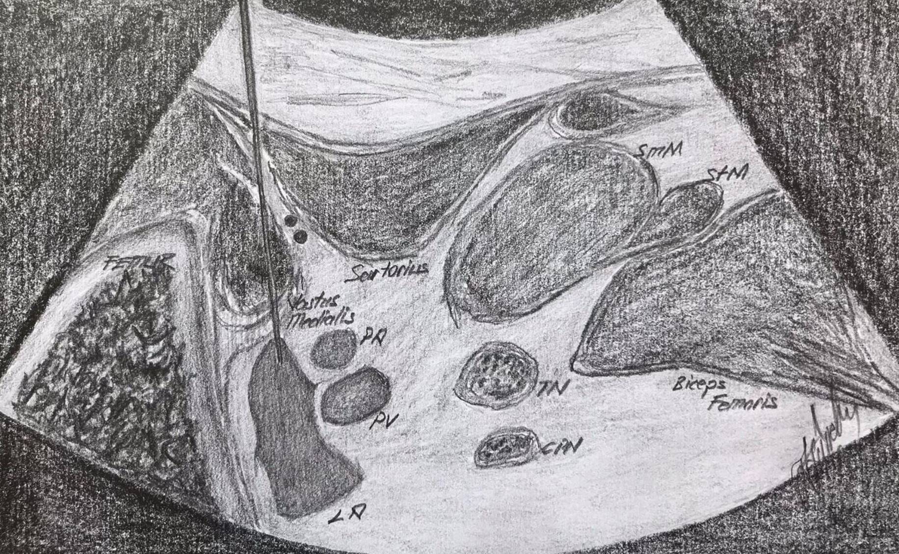 IPACK block; Reverse Ultrasound Anatomy. SmM, semimembranosus 
muscle; StM, semitendinosus muscle; PA, popliteal artery; PV, popliteal vein; TN, 
tibial nerve; CPN, common peroneal nerve; LA, local anaesthetic.