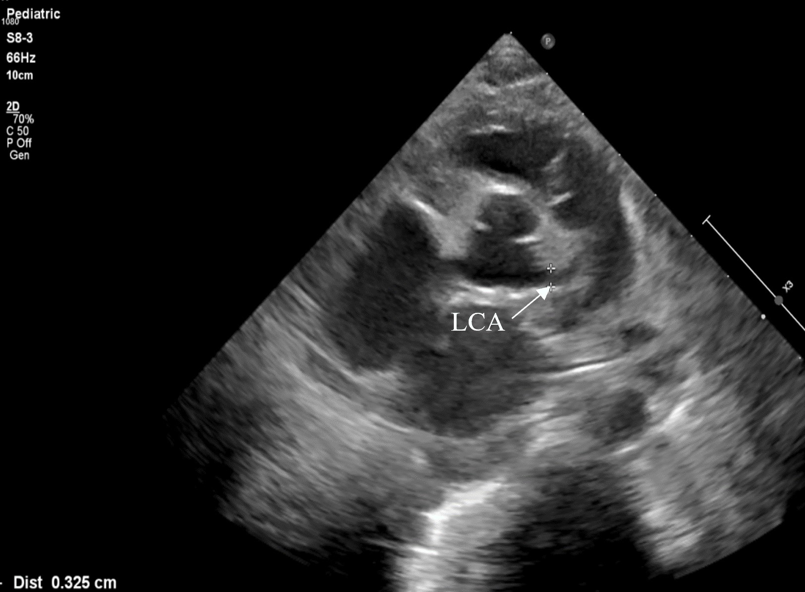 The ultrasound of the heart—view of short parasternal axis. In this view, a dilated left coronary artery is being measured (3.25 mm). 
LCA—left coronary artery.