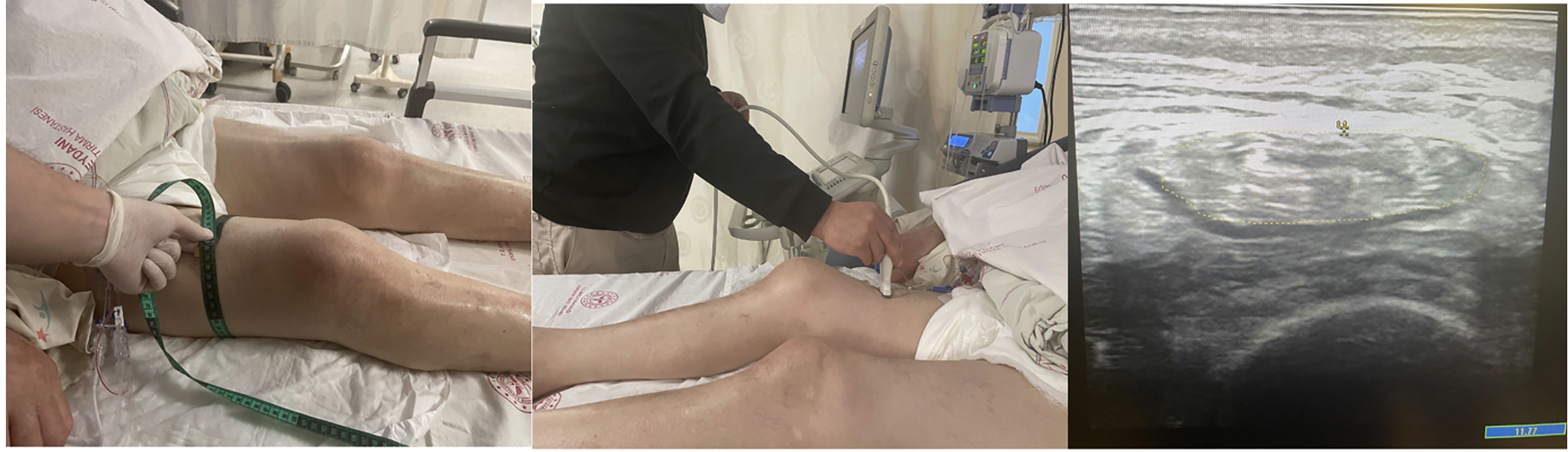 Anthropometric and ultrasonographic measurements of the muscle
mass of bilateral rectus femoris muscles.