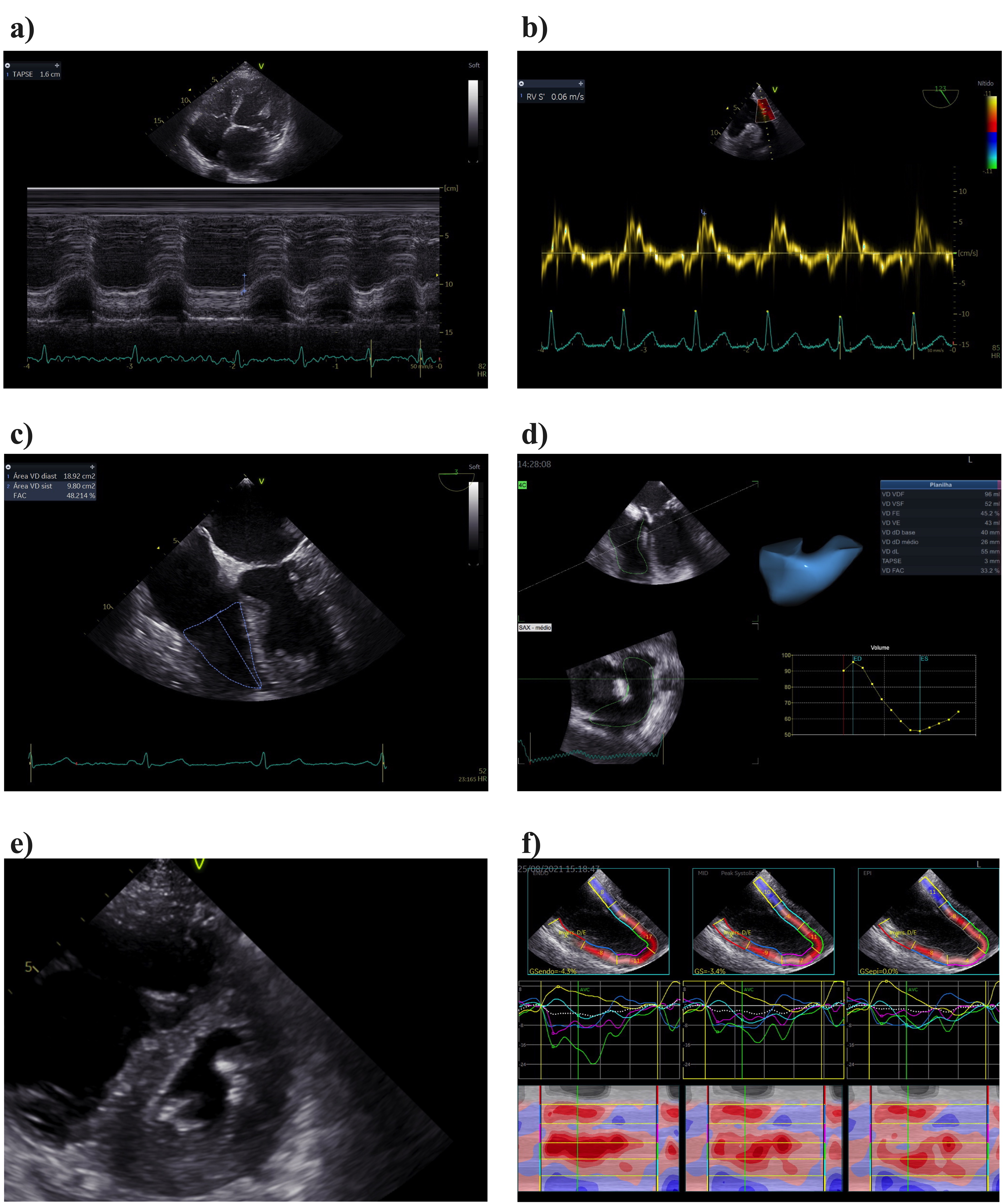 Validation of the Tricuspid Annular Plane Systolic Excursion