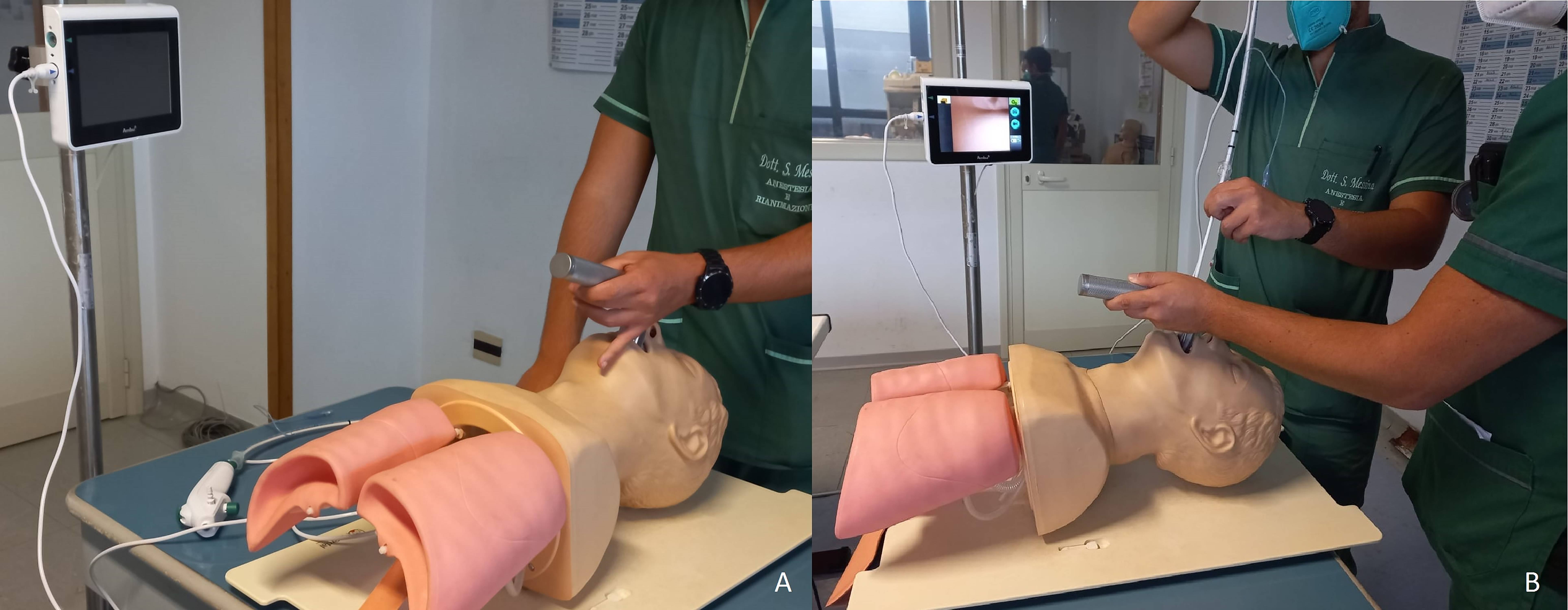 CLBI. A: Direct Laryngoscopy with
Macintosh blade; B: Combined laryngo-bronchoscope intubation.