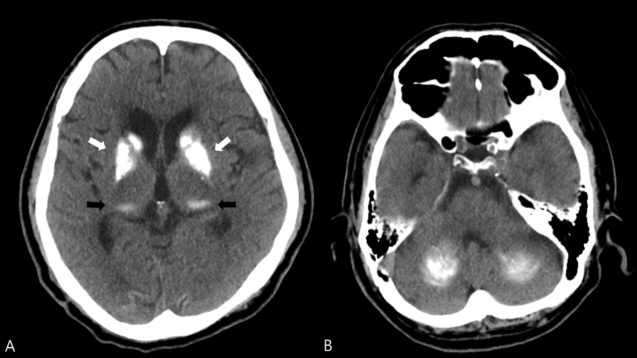 Brain CT scans showing
symmetric calcifications. (A) Basal ganglia (white arrow) and thalamus (black
arrow), and (B) dentate nucleus of the cerebellum.