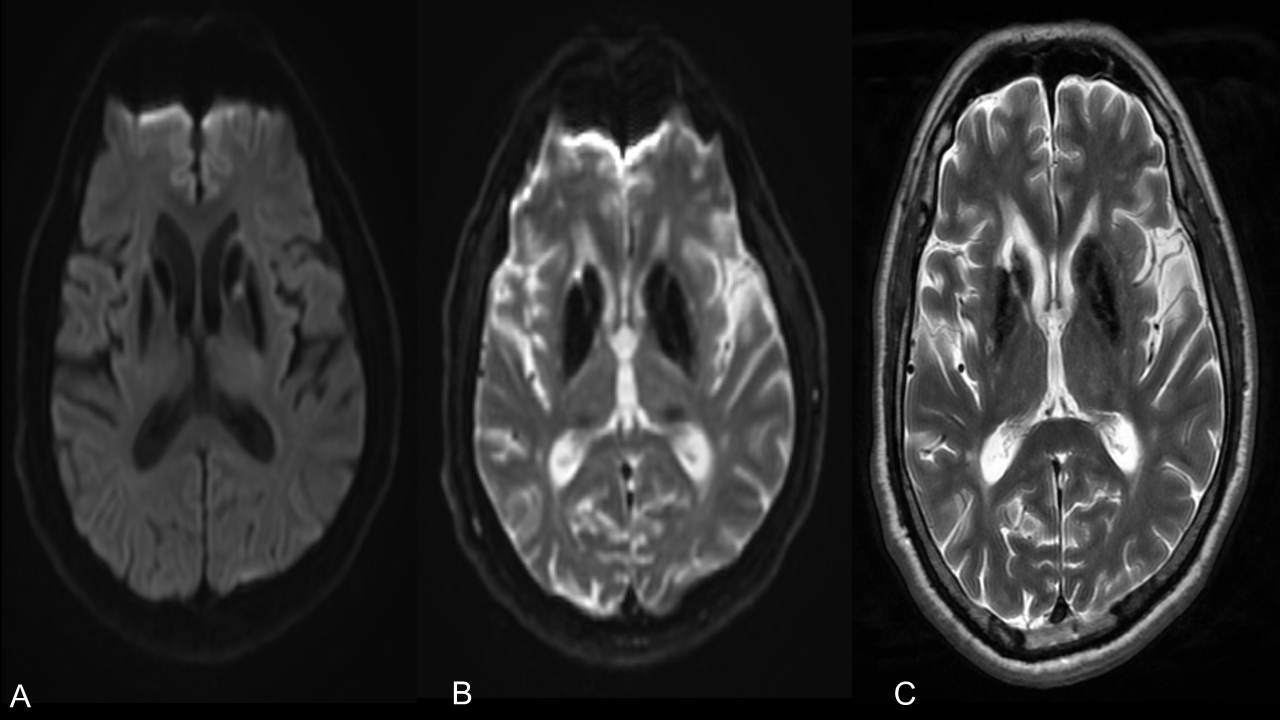 Brain MRI showing symmetric
calcifications. (A) Diffusion-weighted image, and (B) apparent diffusion
coefficient map with low signal intensity in both basal ganglia, but no
restricted diffusion. (C) T2-weighted image with low signal intensity in both
basal ganglia.