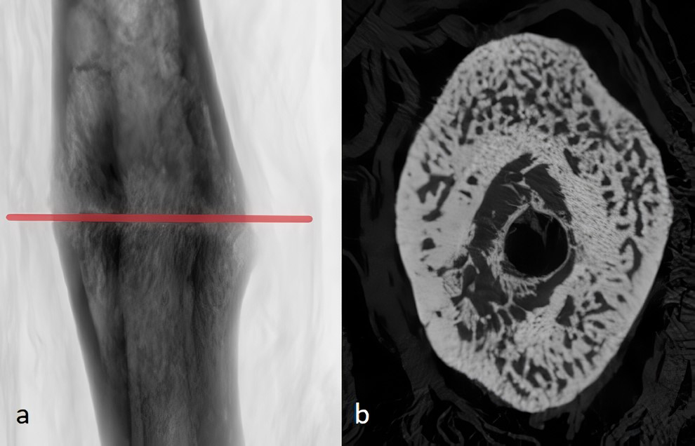 Micro-computed tomography sample of splenectomy group at the
fifth week; determination of the region of interest (ROI). ROI covered a total
range of 8.4 mm (encompassing 4.2 mm proximal and distal to the fracture line
(red line) (a), axial section of fracture line (red line). Callus tissue with
complete maturation is observed. It is understood that the callus tissue is
mineralized (maturation) by giving signals close to the cortical bone in the grey
scale (b).