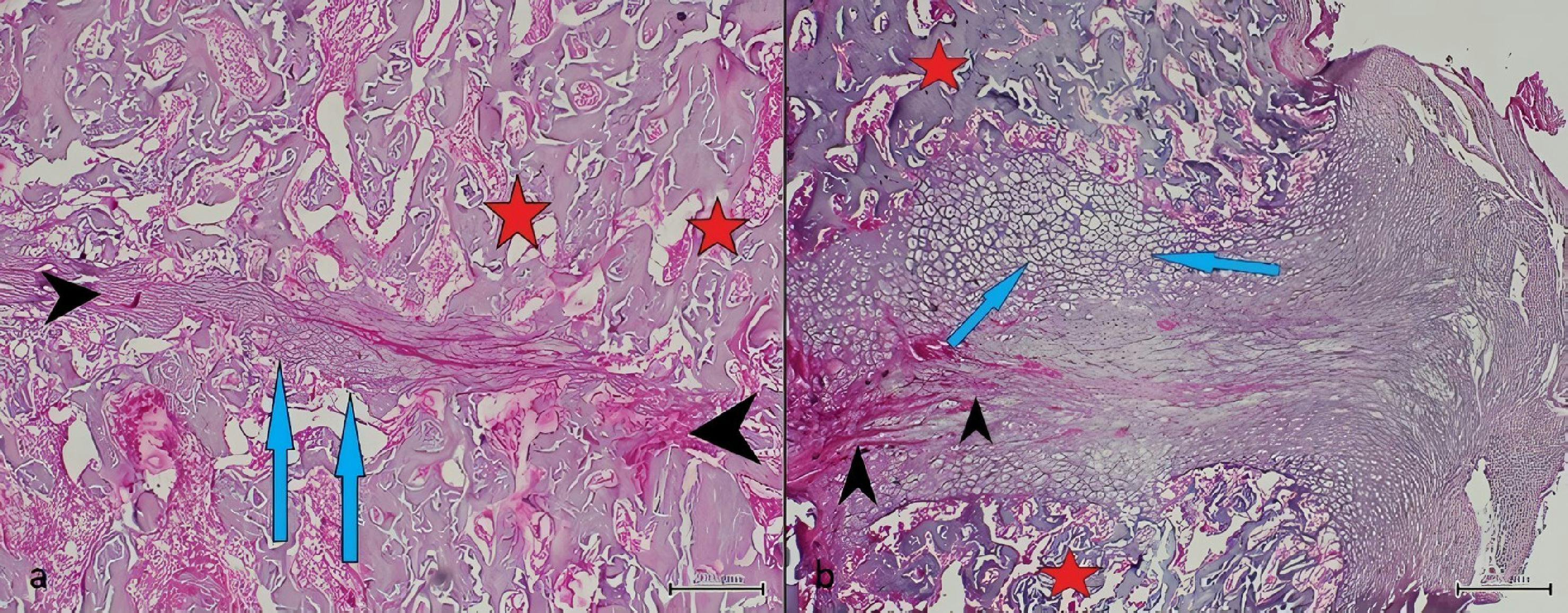 Fifth week histological sections, black arrows indicate fibrous
tissue; blue arrows indicate cartilage tissue, and asterisks indicate immature
bone tissue. Although fibrous tissue is seen in the fracture line of Groups C,
cartilage tissue and immature bone areas are also seen (a). In Groups D, which
did not undergo splenectomy, the fracture line was observed to merge with
cartilage tissue and immature bone (b).