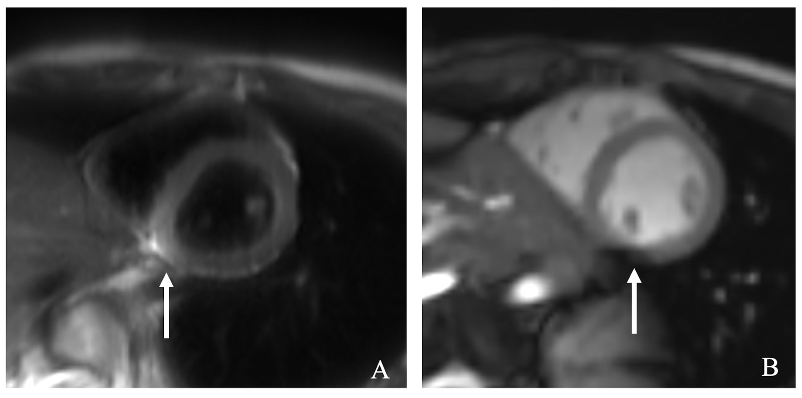 Cardiac magnetic resonance
imaging of the case. The cardiac magnetic resonance imaging (CMRI) on day 31
reveals a left ventricular ejection fraction of 61% and a normal left
ventricular volume, with hypokinesis in the basal and mid-posterolateral
segments. These segments display a high-intensity area on the T2 weighted image
(A, arrow) and delayed gadolinium enhancement in the T1 weighted image (B,
arrow), indicating myocardial edema or fibrosis. Based on these findings, the
diagnosis of fulminant myocarditis was established.