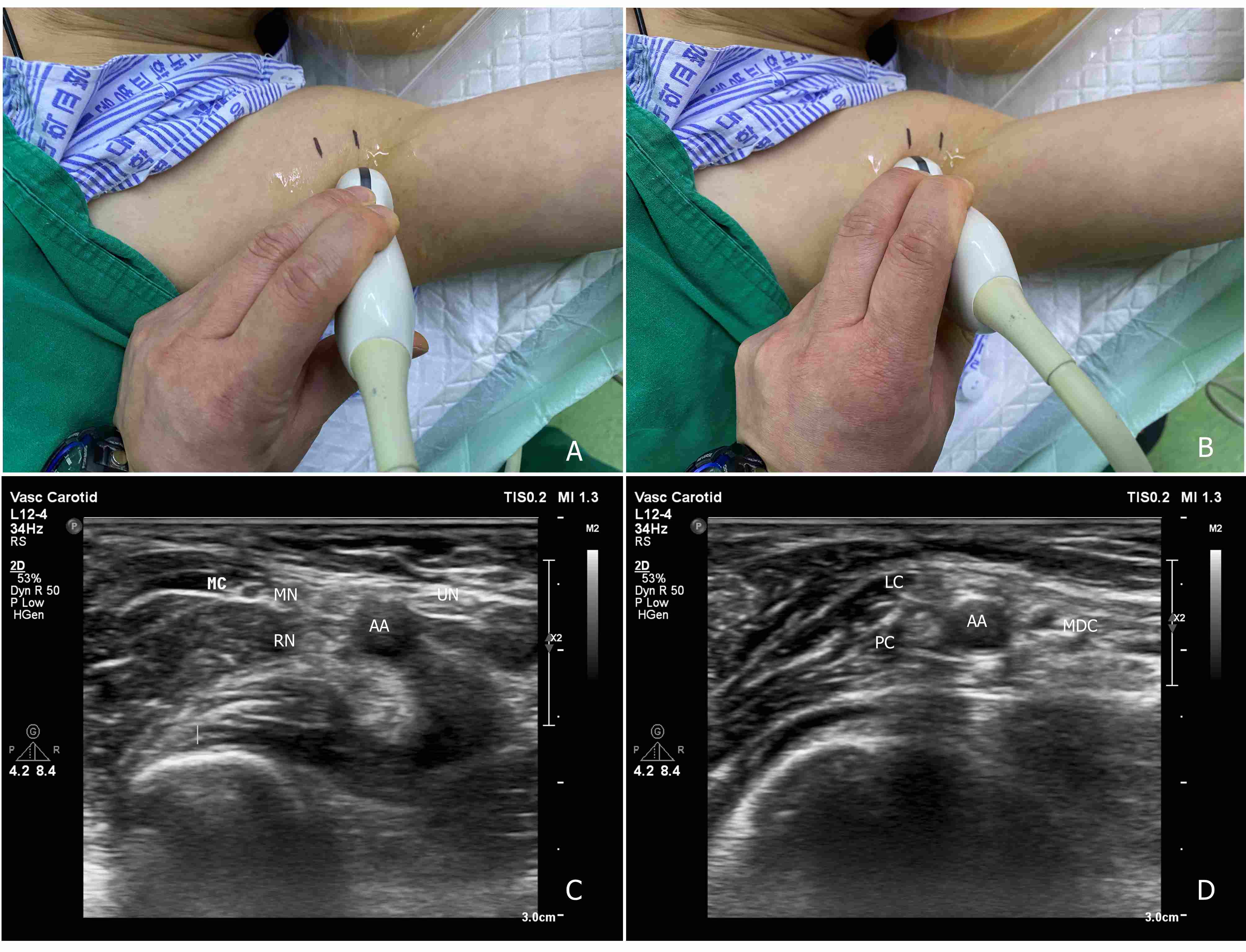 Ultrasound images of the
brachial plexus and the position of the ultrasound probe. (A) brachial plexus
with four nerve branches, including the median (MN), ulnar (UN), radial (RN), and
musculocutaneous (MC) nerves. (B) Brachial plexus with three cords: the lateral
cord (LC), medial cord (MDC) and posterior cord (PC). (C): Ultrasound image of
Fig. 1A. (D) Ultrasound image of Fig. 1B.