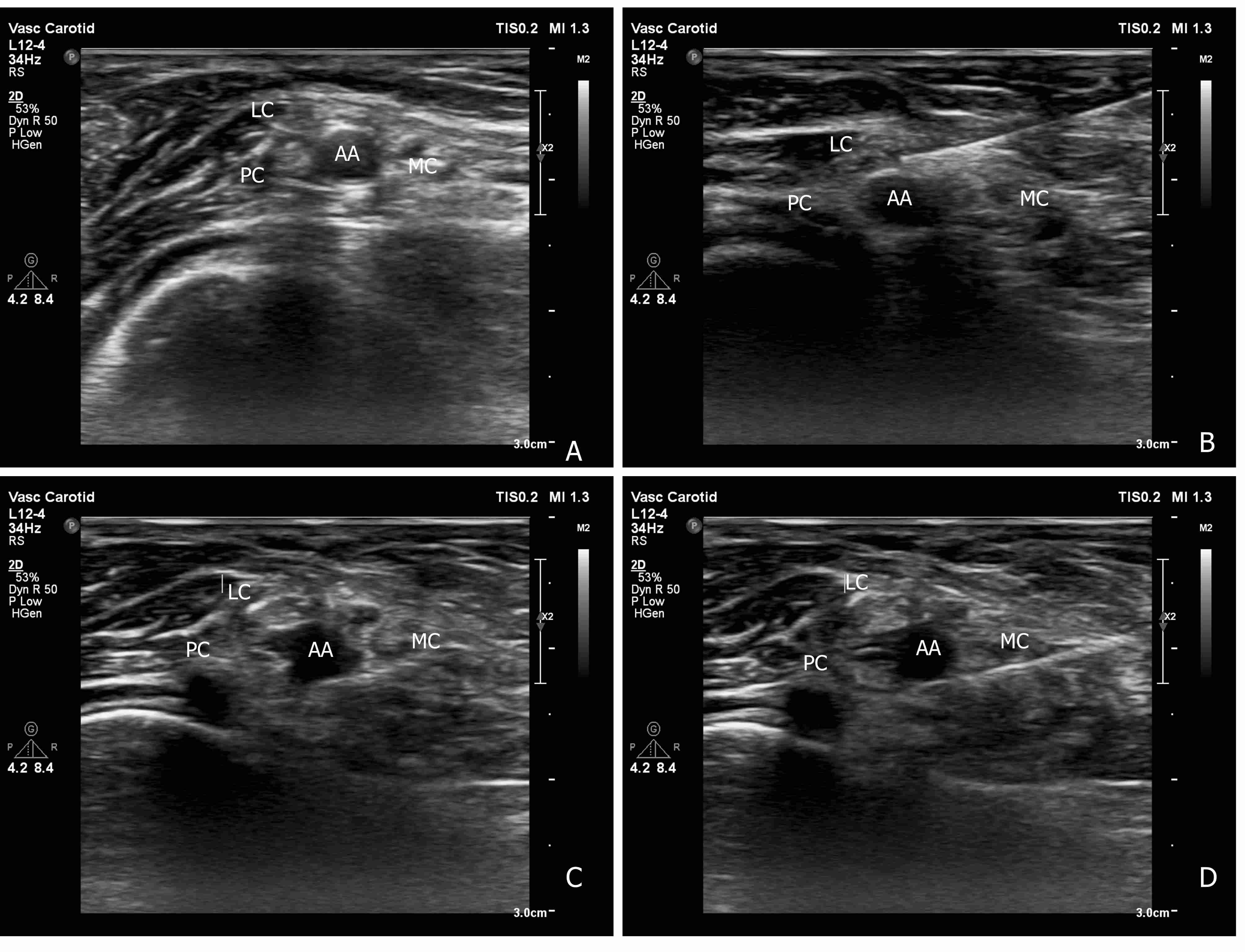 Ultrasound image of the
proximal perivascular block. (A) Brachial plexus with three cords: the lateral
cord (LC), medial cord (MDC), and posterior cord (PC). (B) Needle was inserted in
the 12-o’clock direction of the axillary artery, and local anesthetic was
injected. (C) Blurring of the axillary artery wall (Silhouette sign). (D) The
needle was inserted in the 6-o’clock direction from the axillary artery.