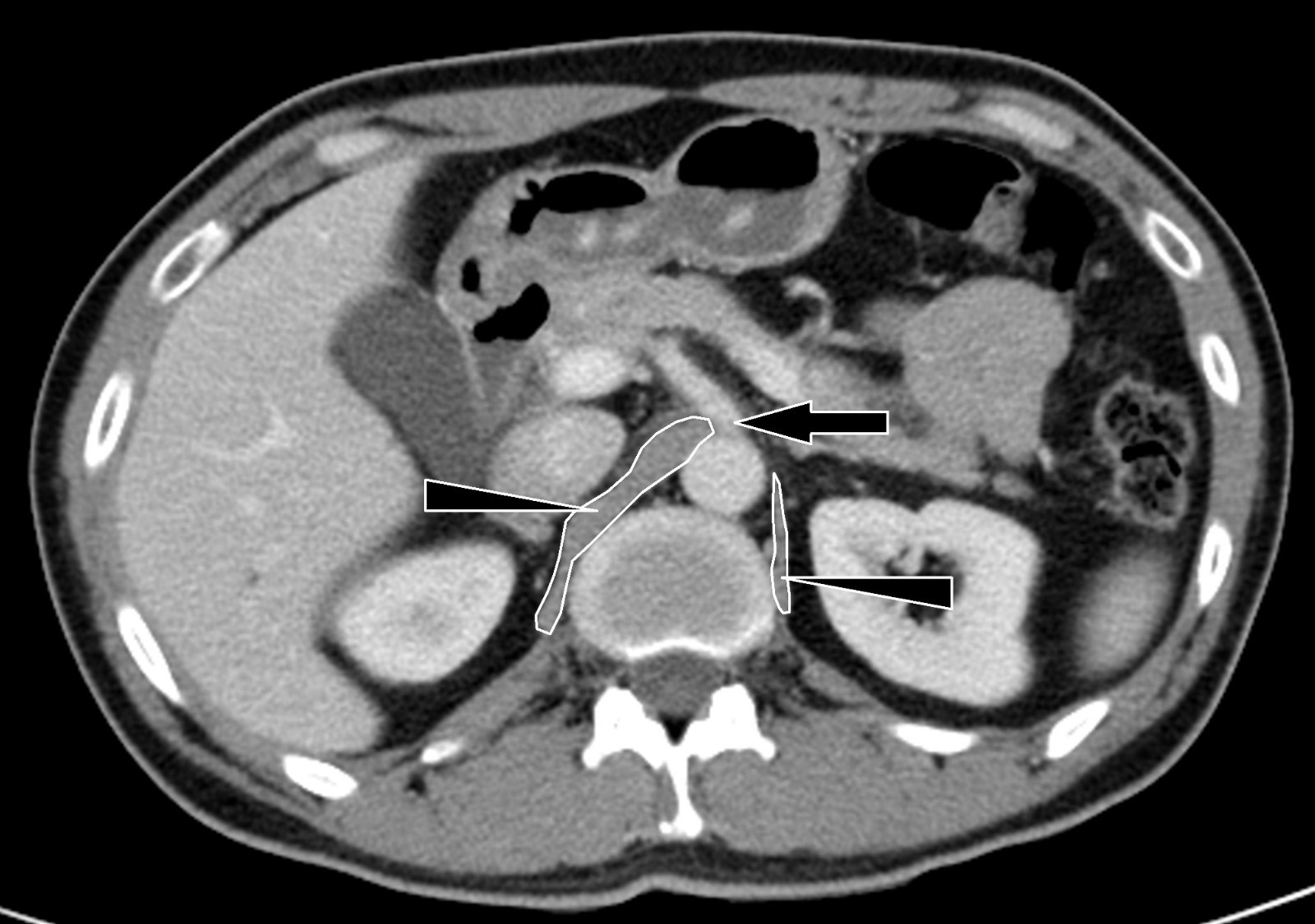 CT scan for measuring the
cross-sectional area of the diaphragmatic crus. DC: diaphragmatic crus. The
cross-sectional area of the DC (white triangle) was measured at the level of the
origin of the celiac trunk (white arrow).